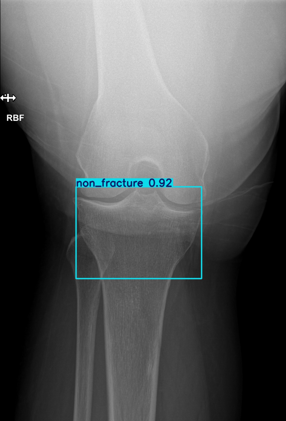 non_fracture_000882870E.jpg