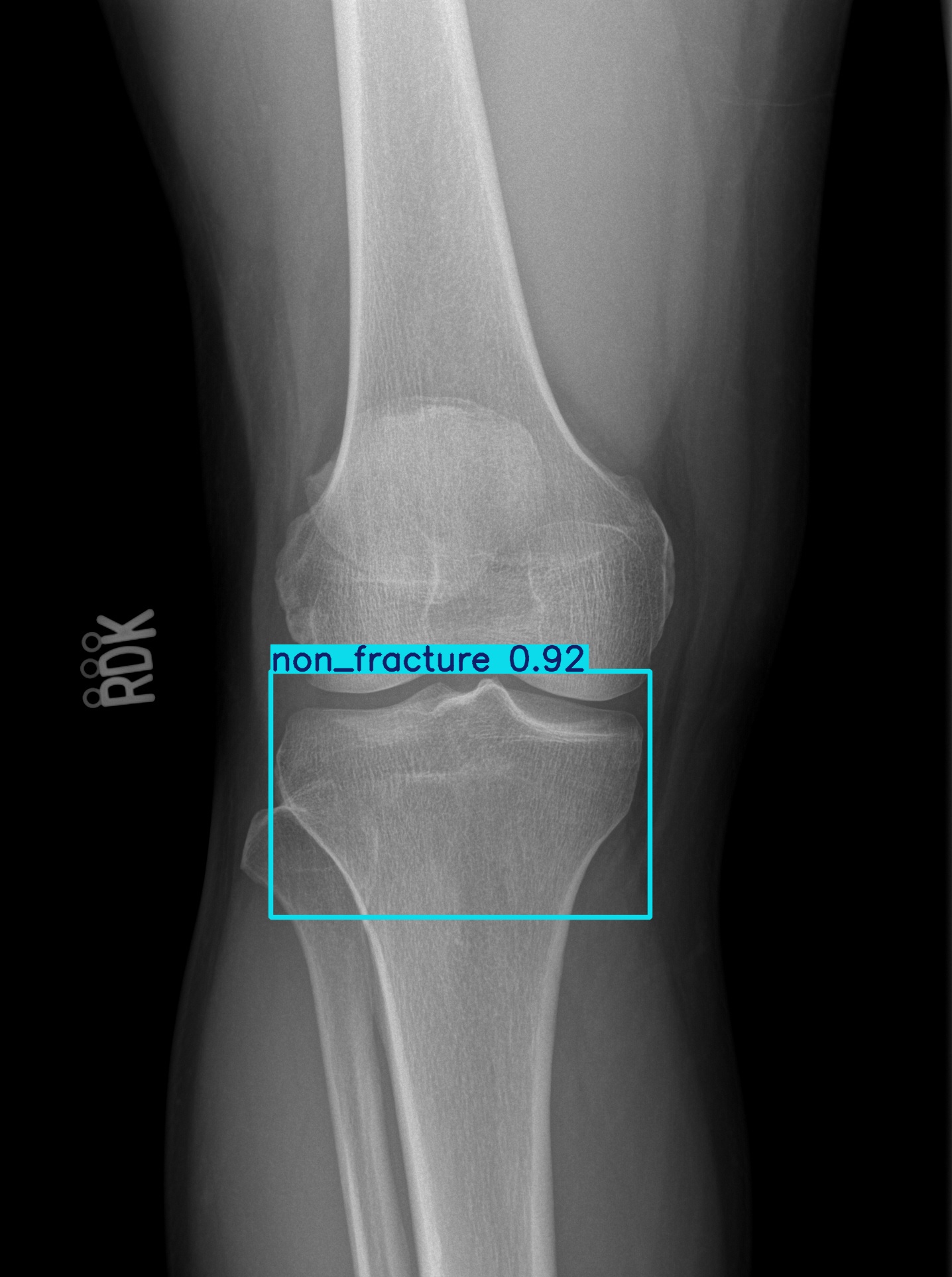 non_fracture_000963324D.jpg