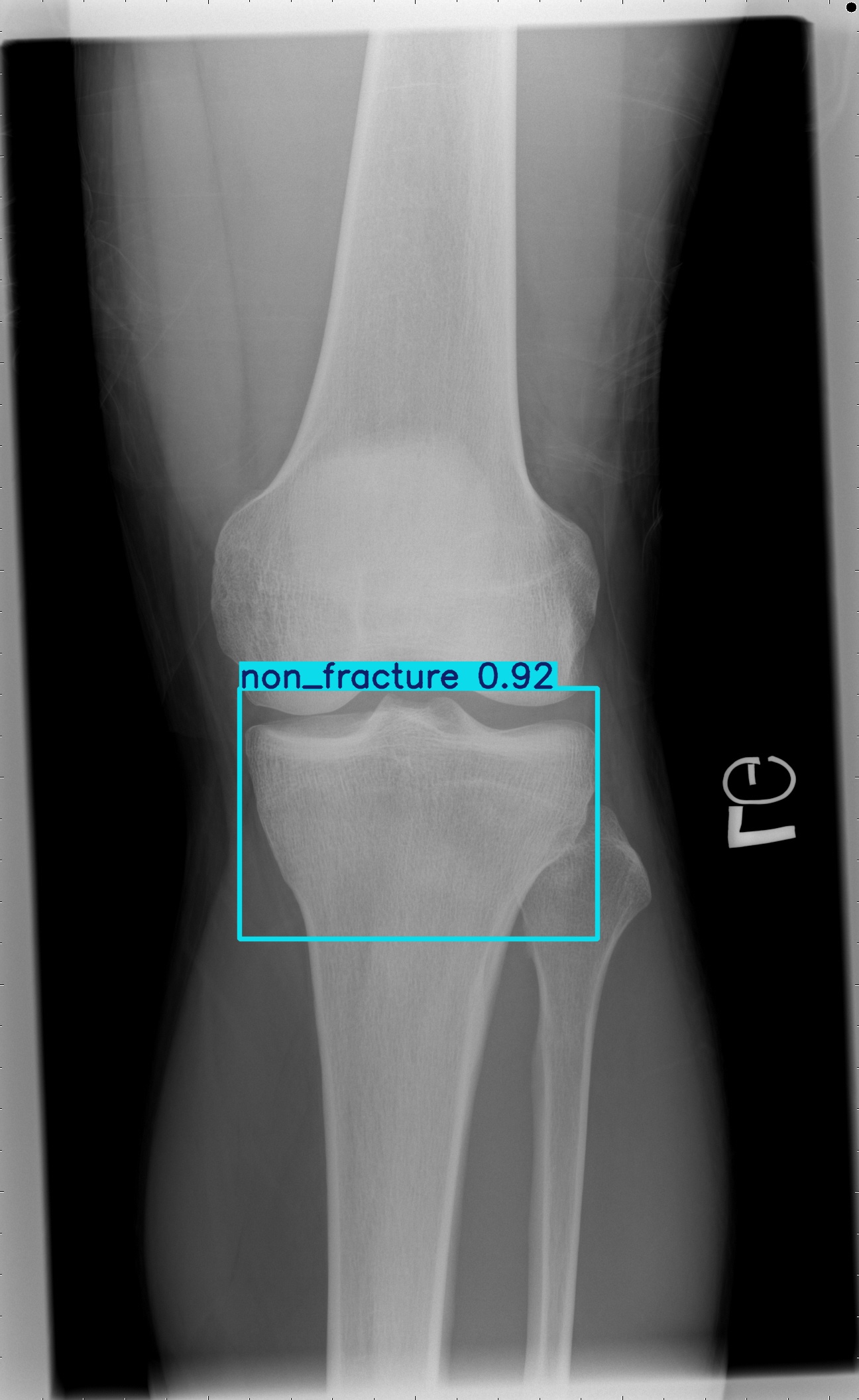 non_fracture_000989846I.jpg