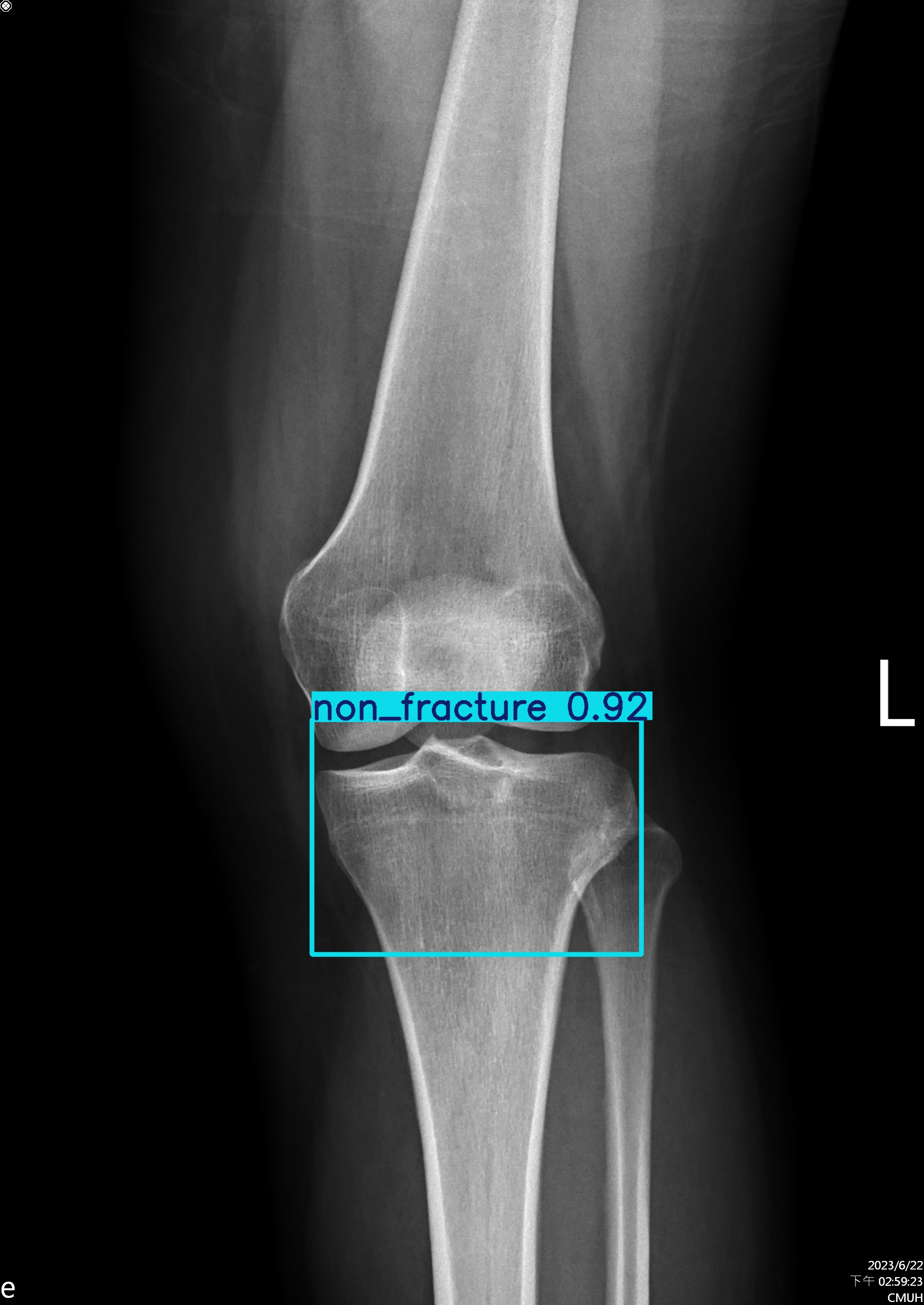 non_fracture_001220694J.jpg