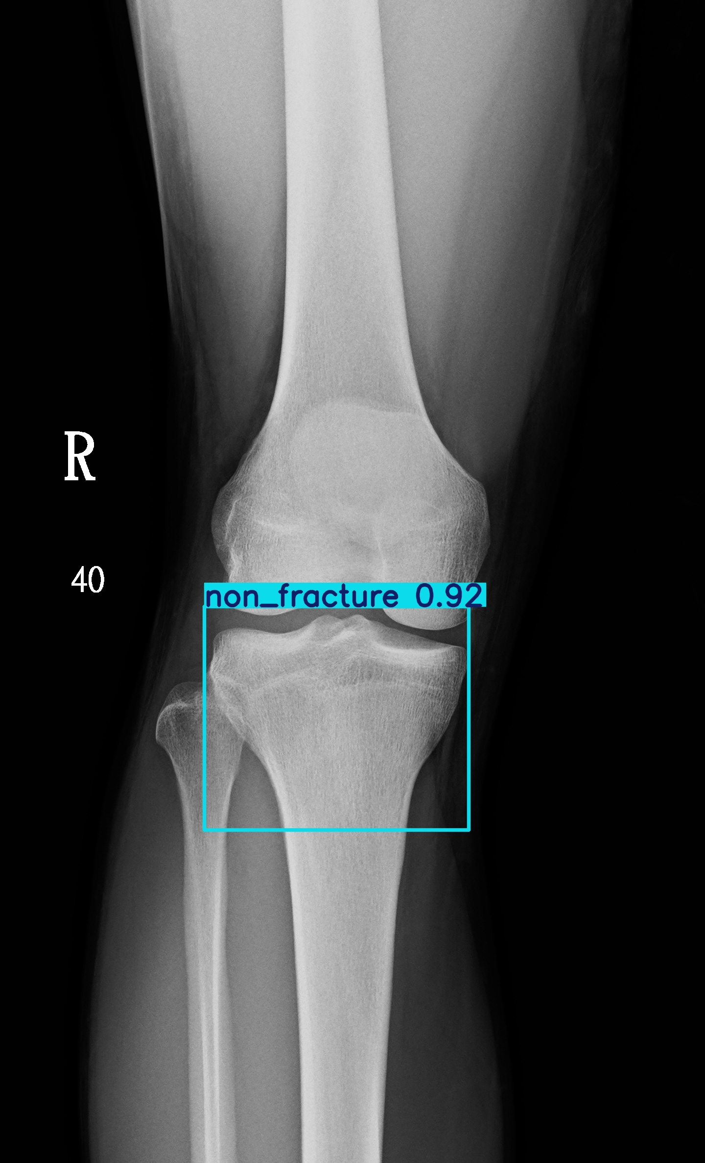 non_fracture_001285851E.jpg