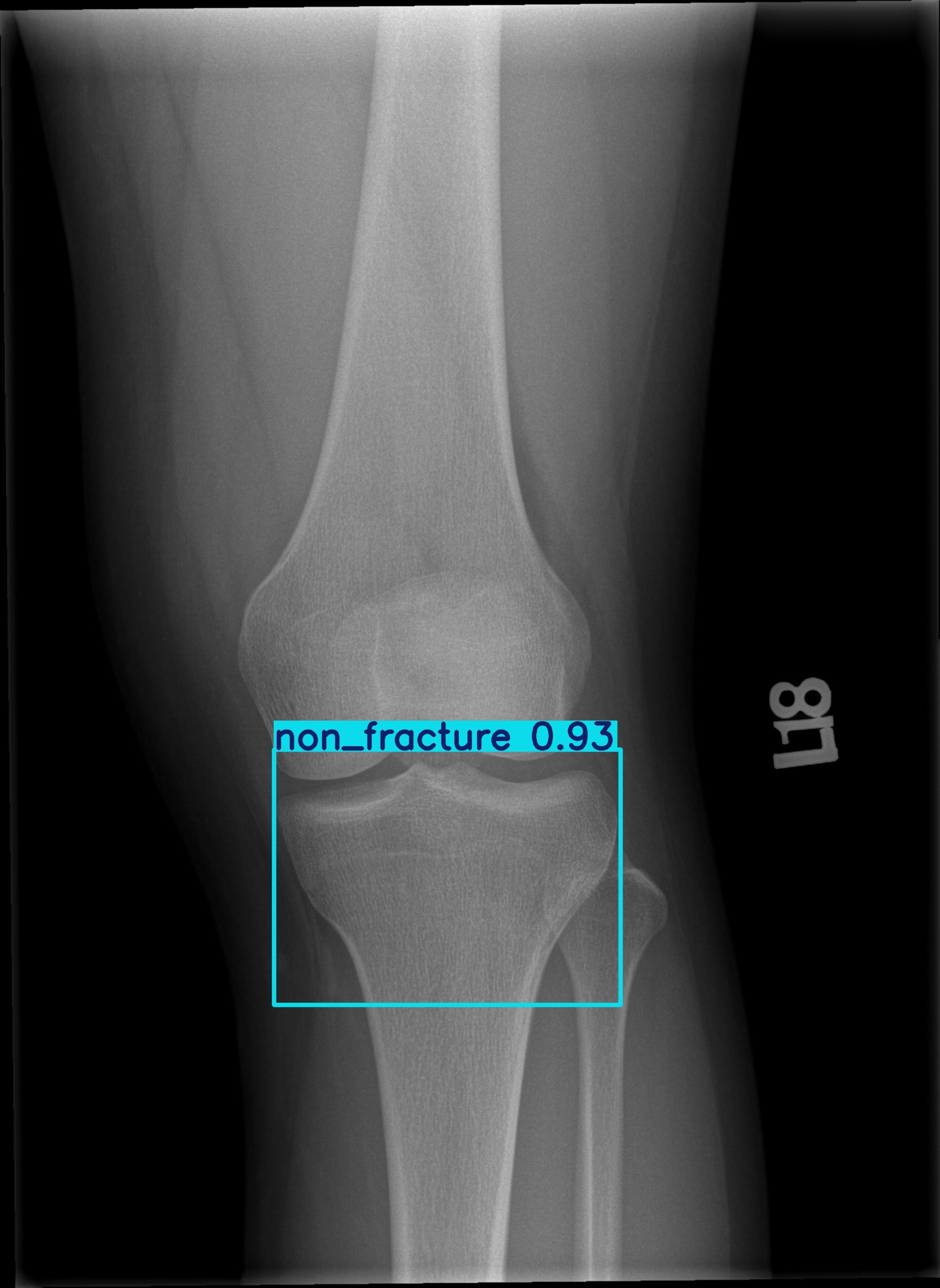 non_fracture_001466719H 2.jpg