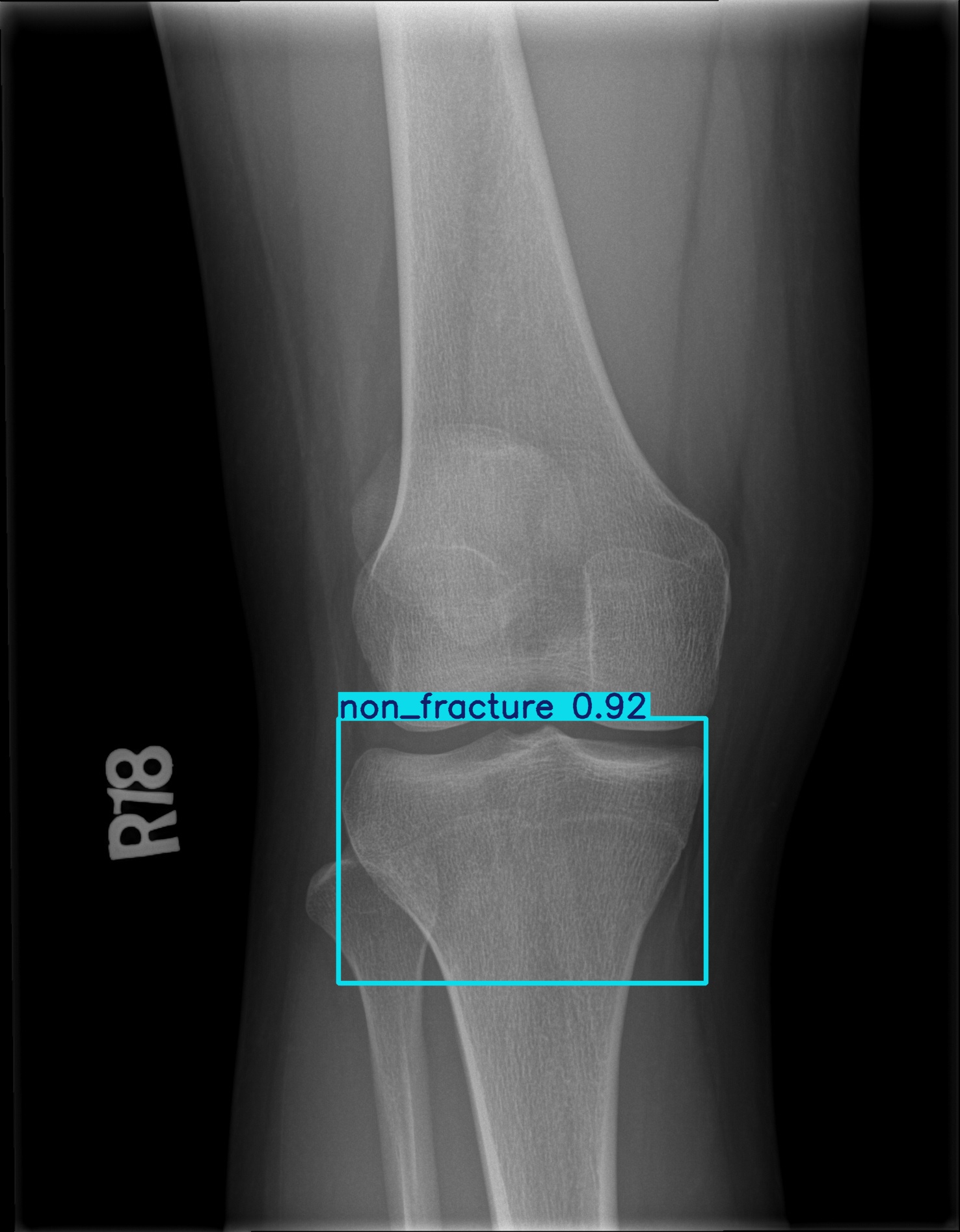 non_fracture_001466719H.jpg