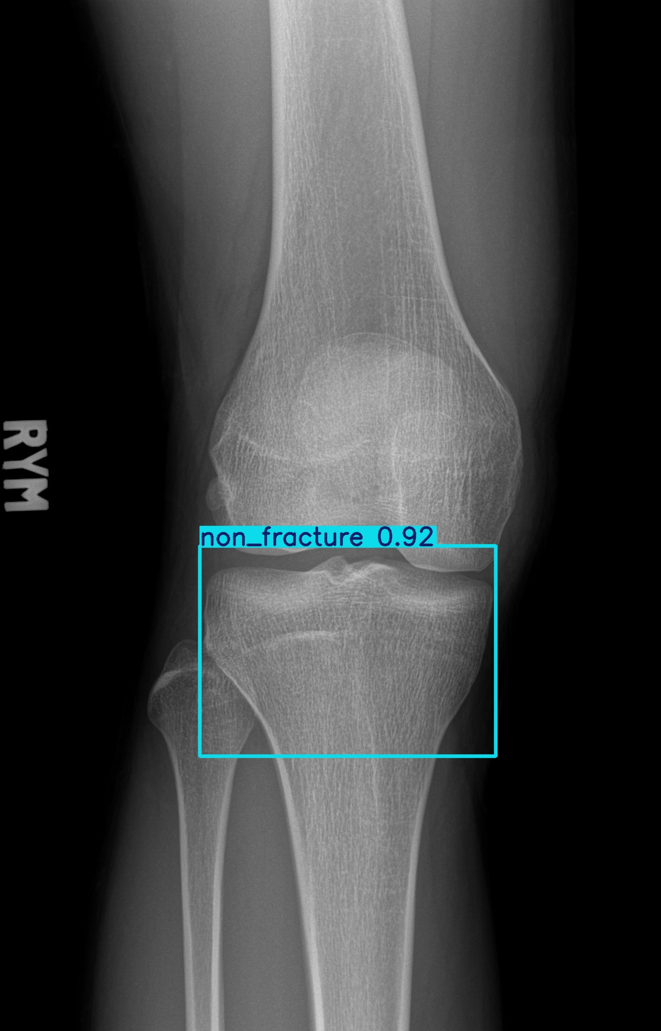 non_fracture_001646208B.jpg