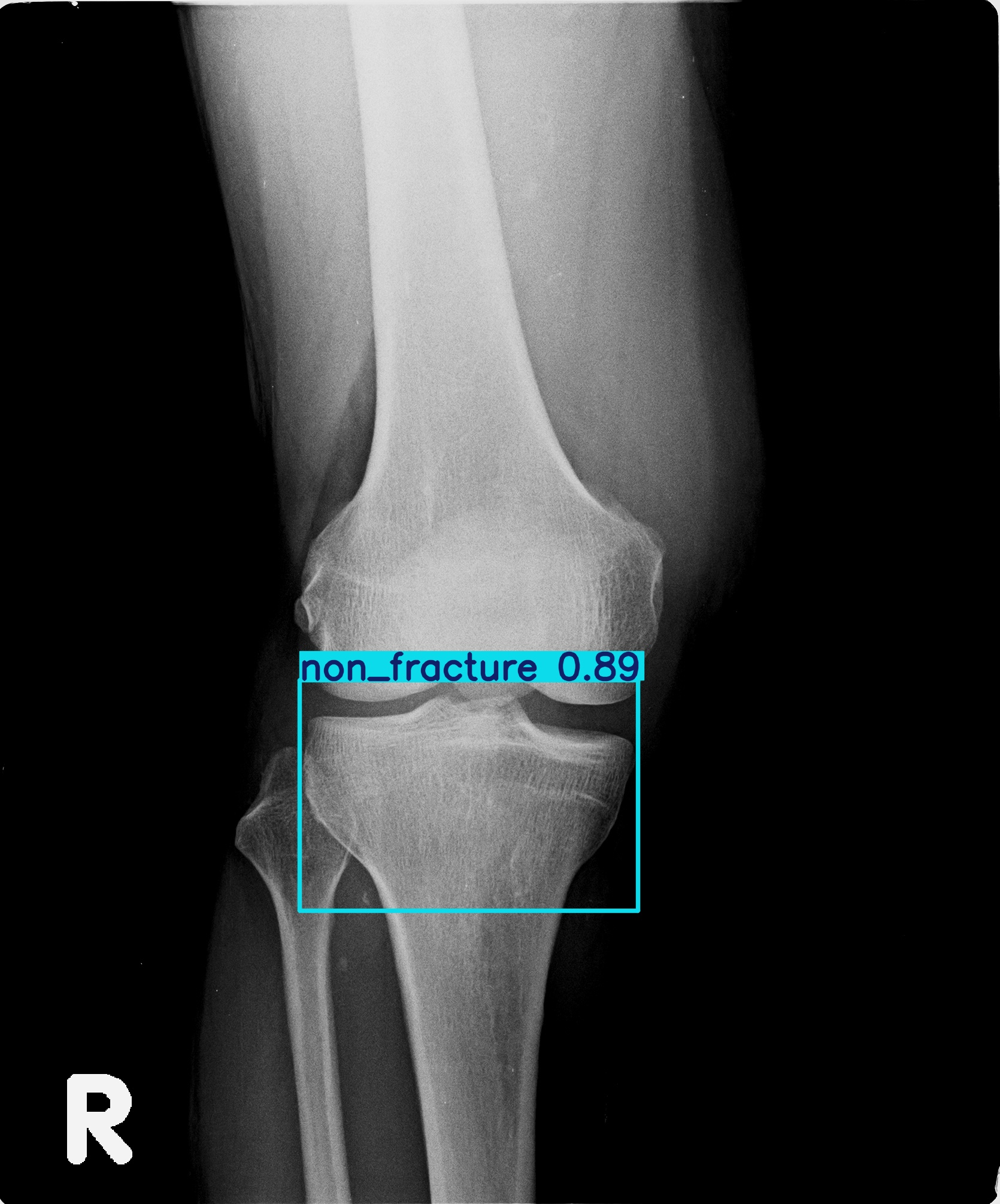 non_fracture_001660738I 2.jpg