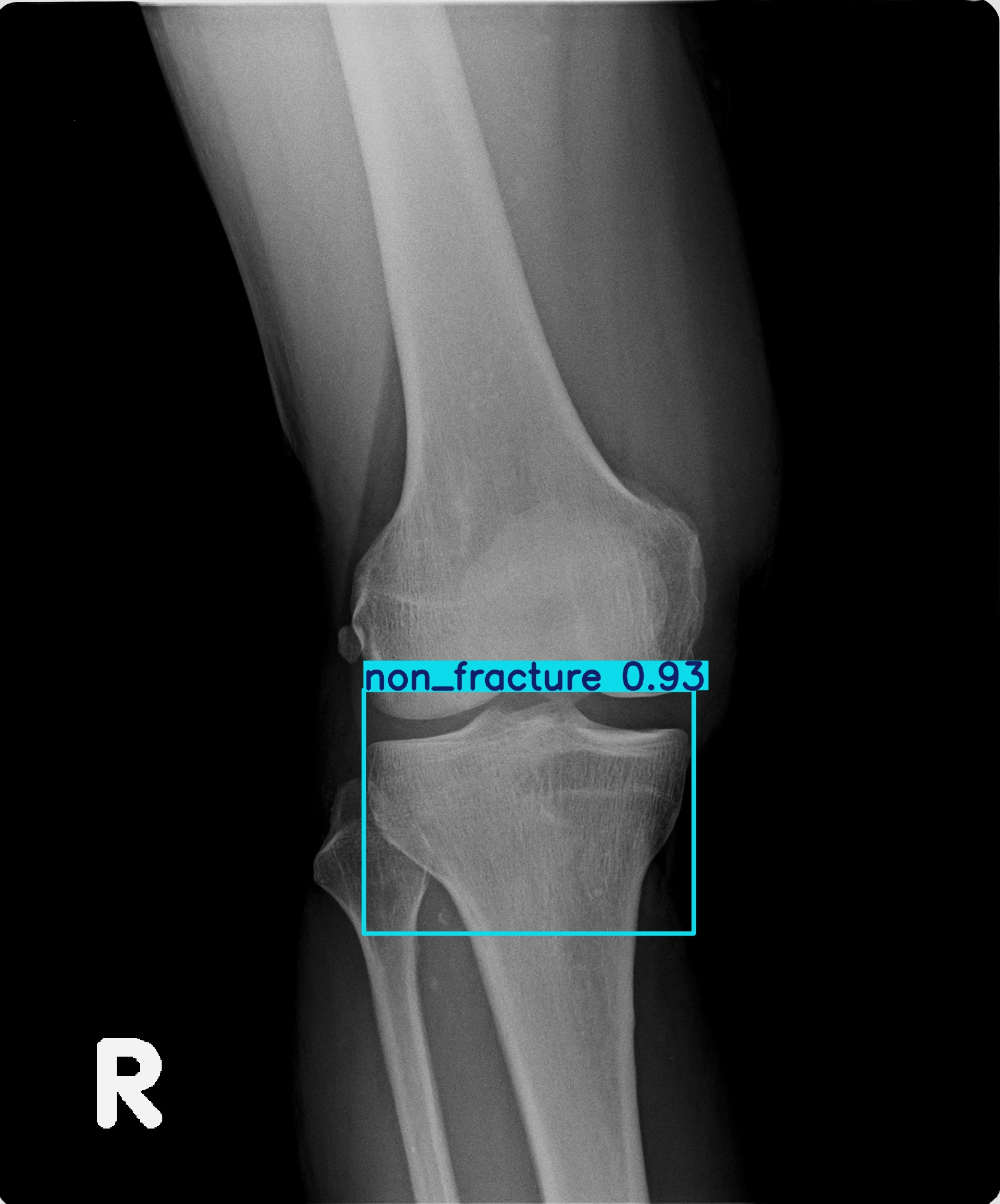 non_fracture_001660738I 3.jpg