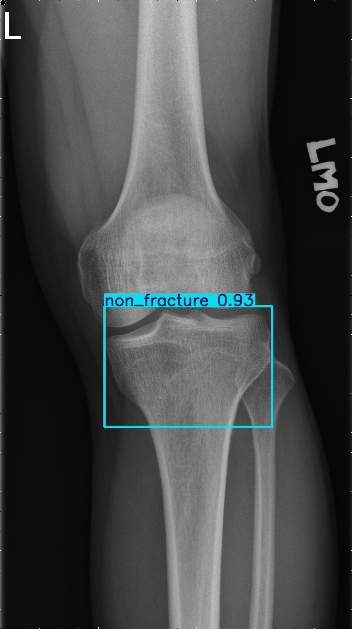 non_fracture_001660738I.jpg