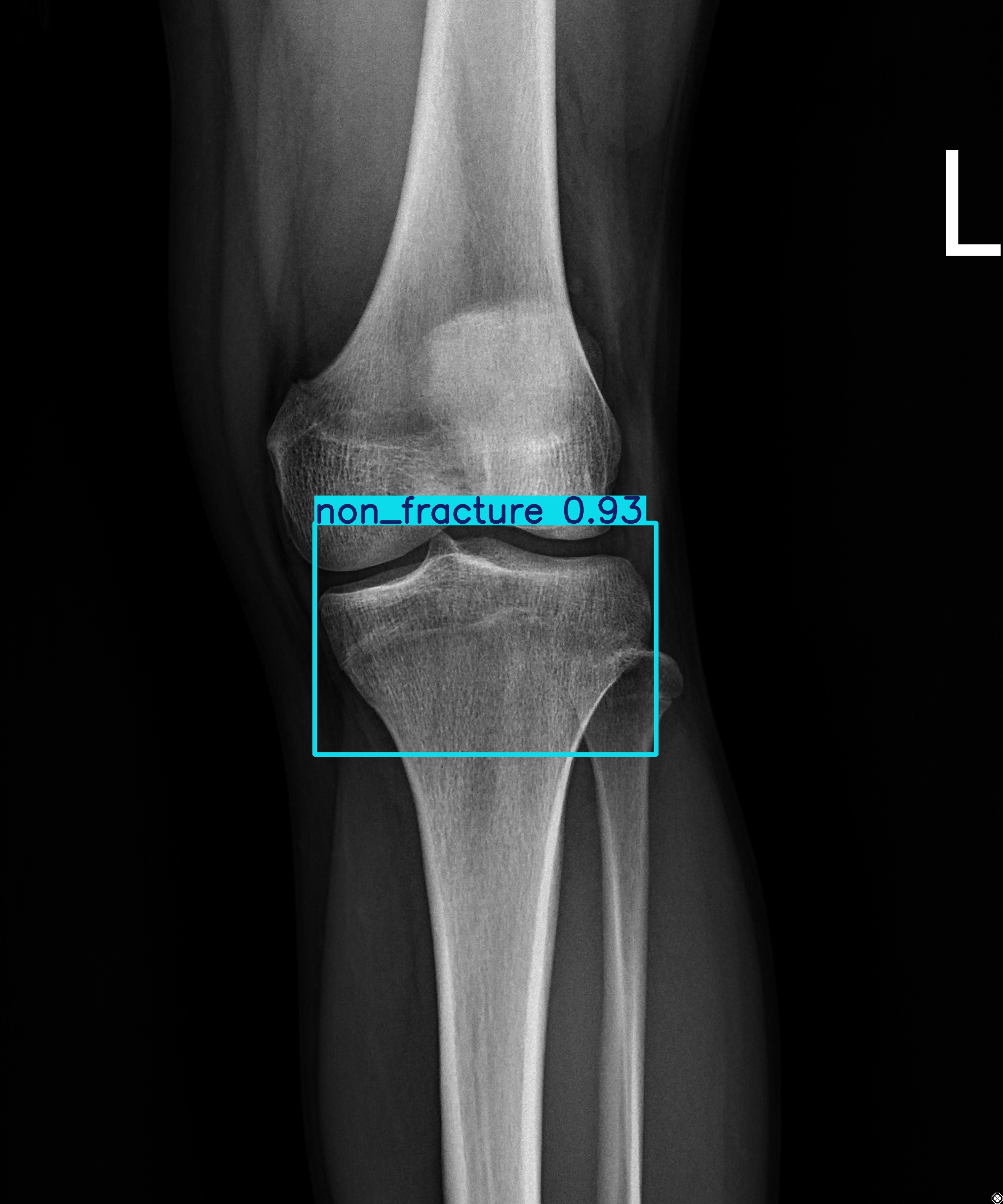 non_fracture_002145661B.jpg
