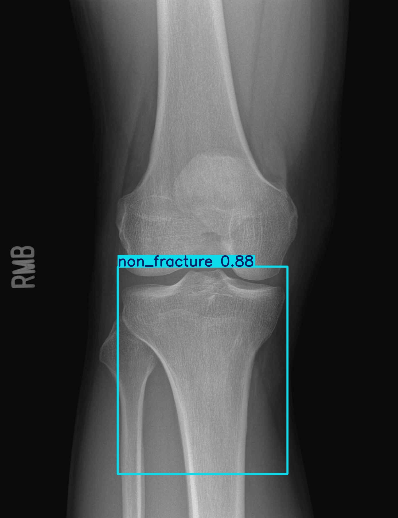 non_fracture_002680829H_12_1_1_1.jpg