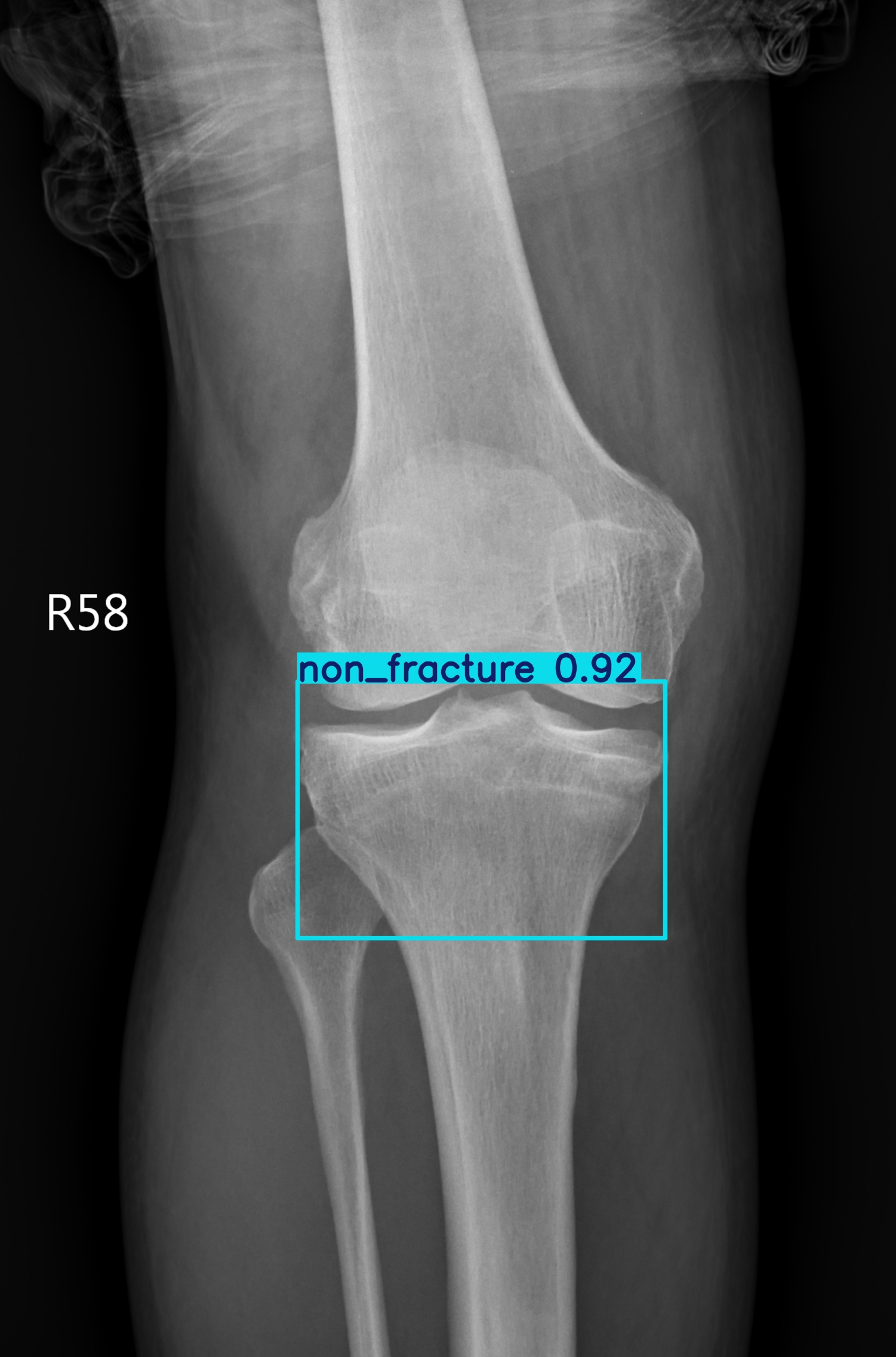 non_fracture_002764677B AP.jpg