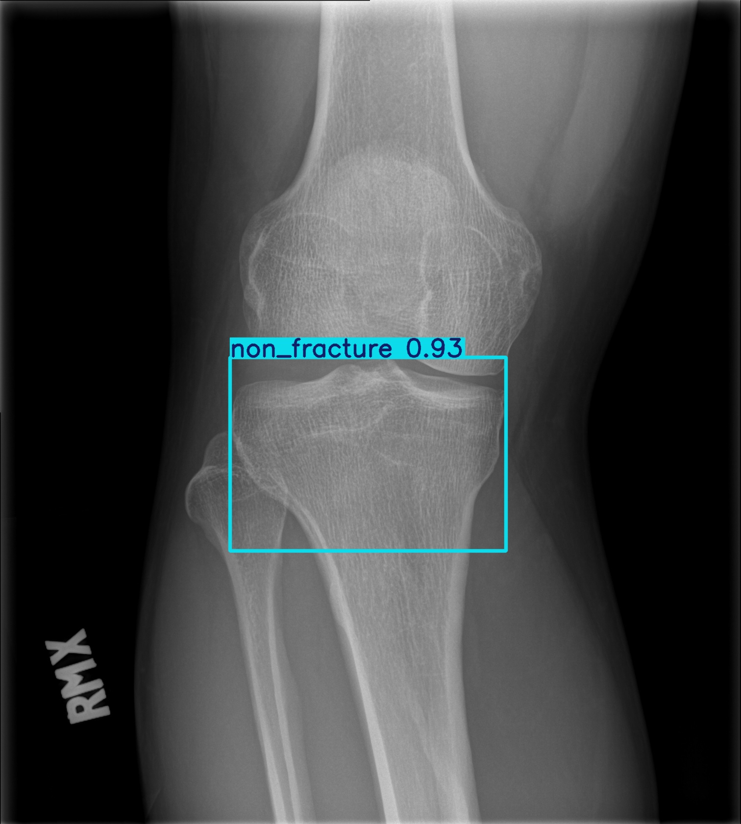 non_fracture_002796804D.jpg