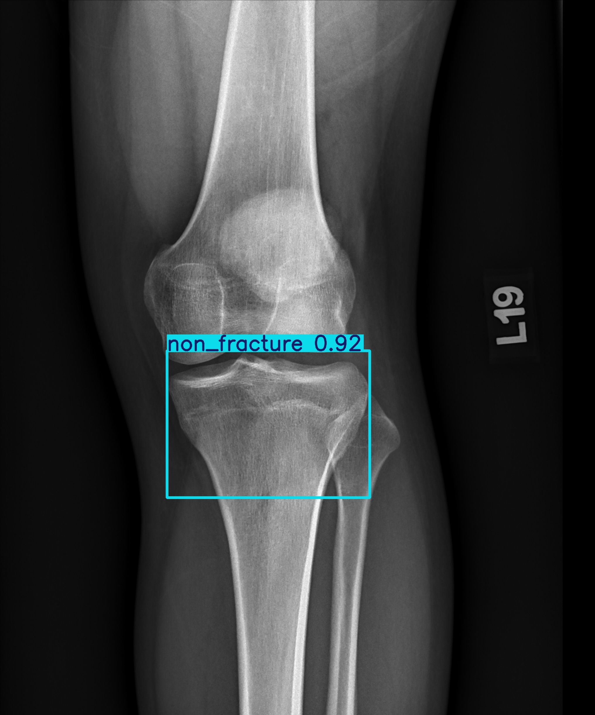 non_fracture_002817955H 2.jpg