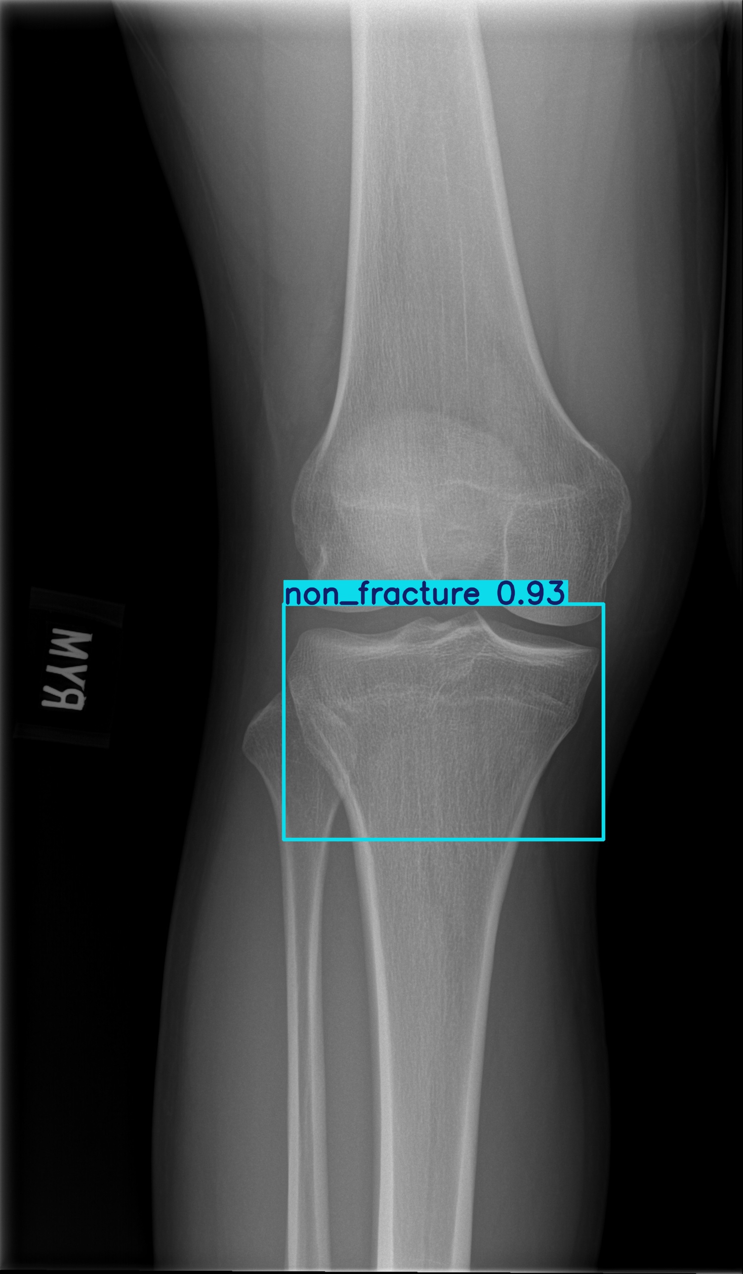 non_fracture_002817955H.jpg