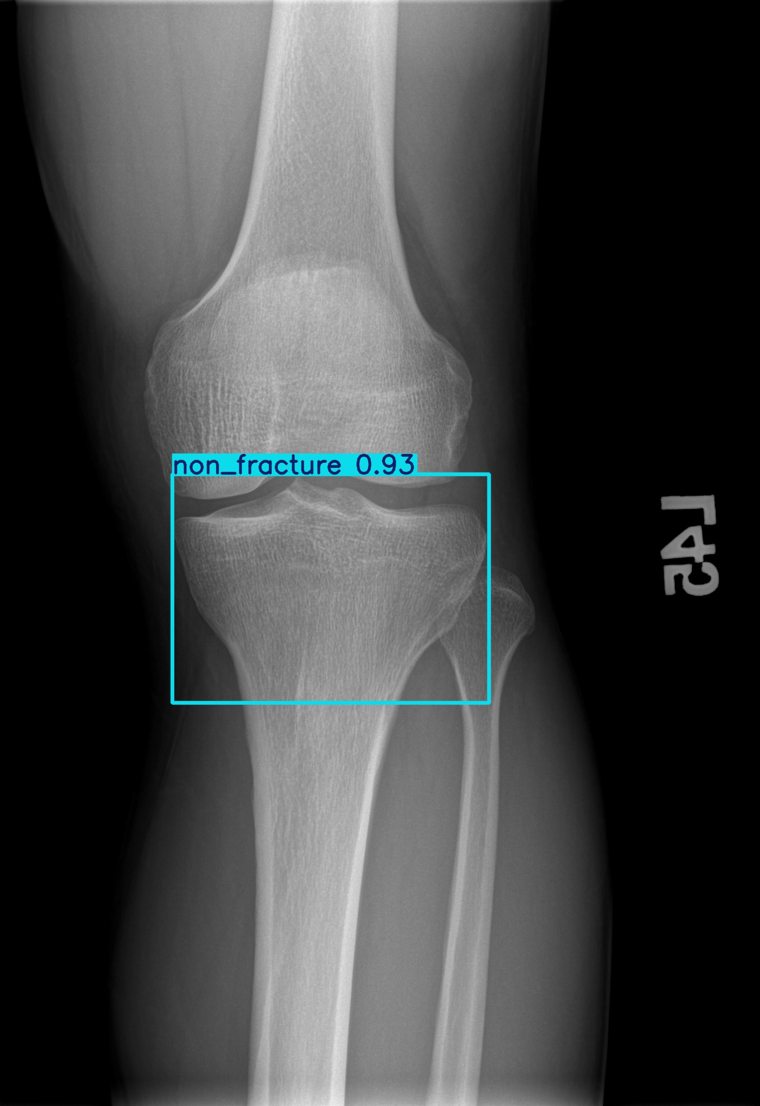 non_fracture_002858494D.jpg