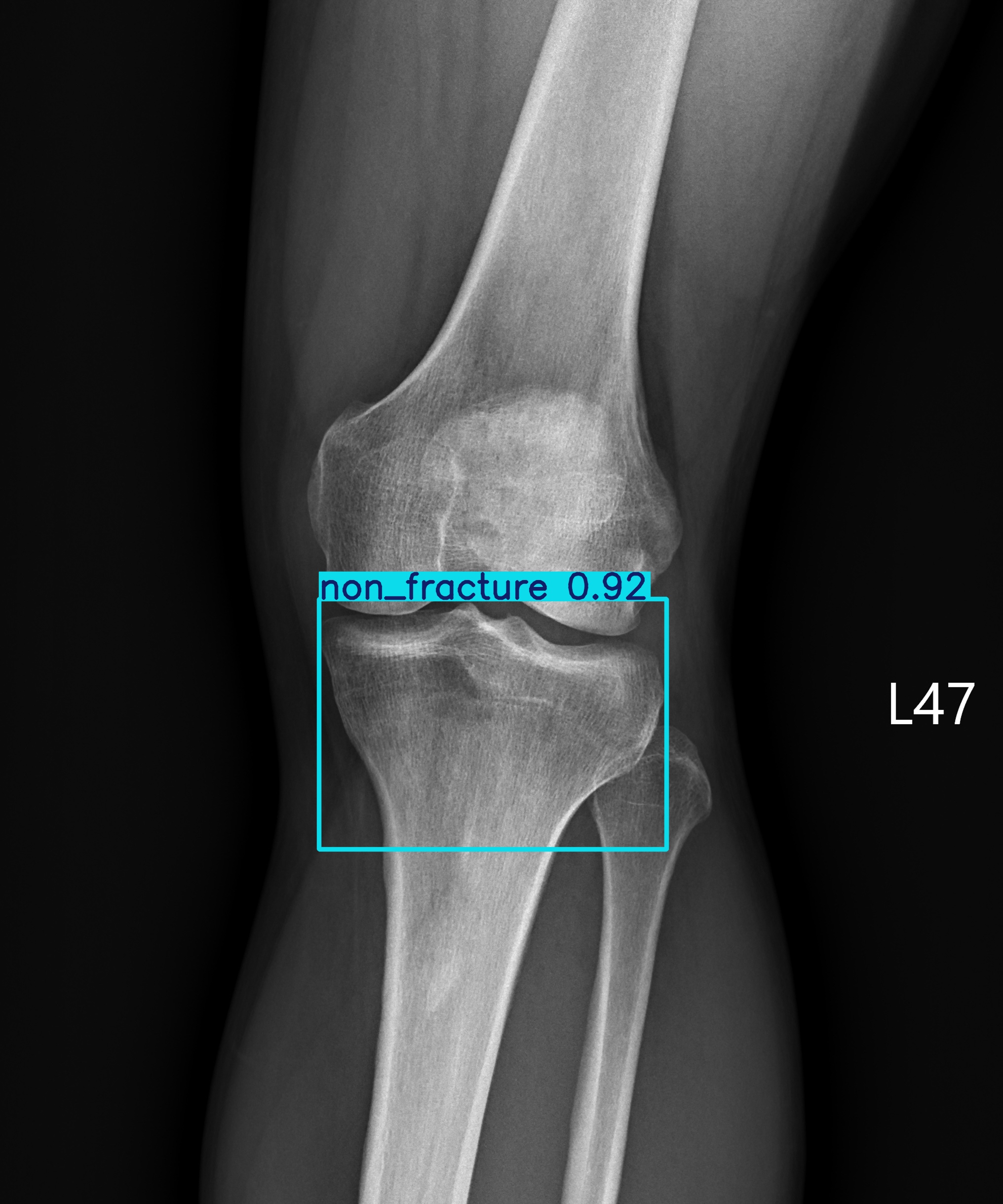 non_fracture_002871313F.jpg