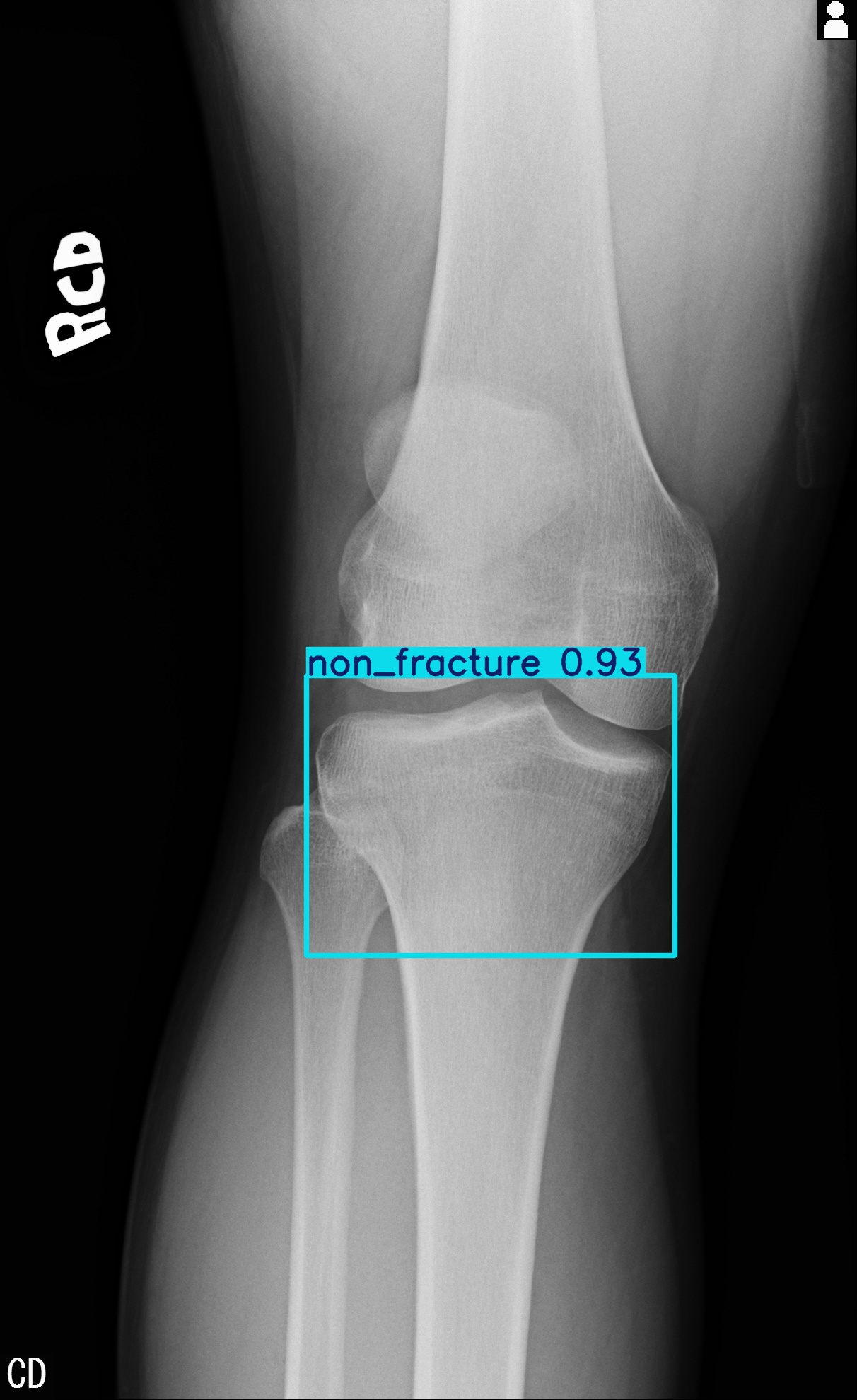 non_fracture_002894698H.jpg