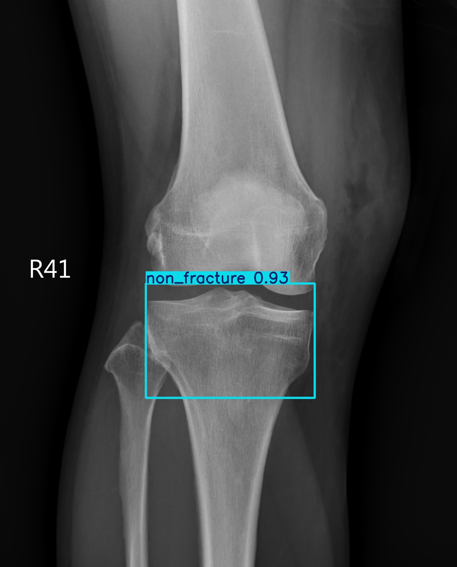 non_fracture_003018139G.jpg