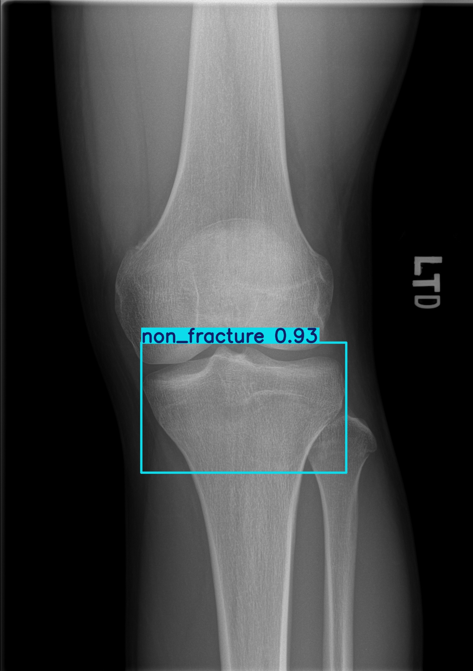non_fracture_003027622D 2.jpg