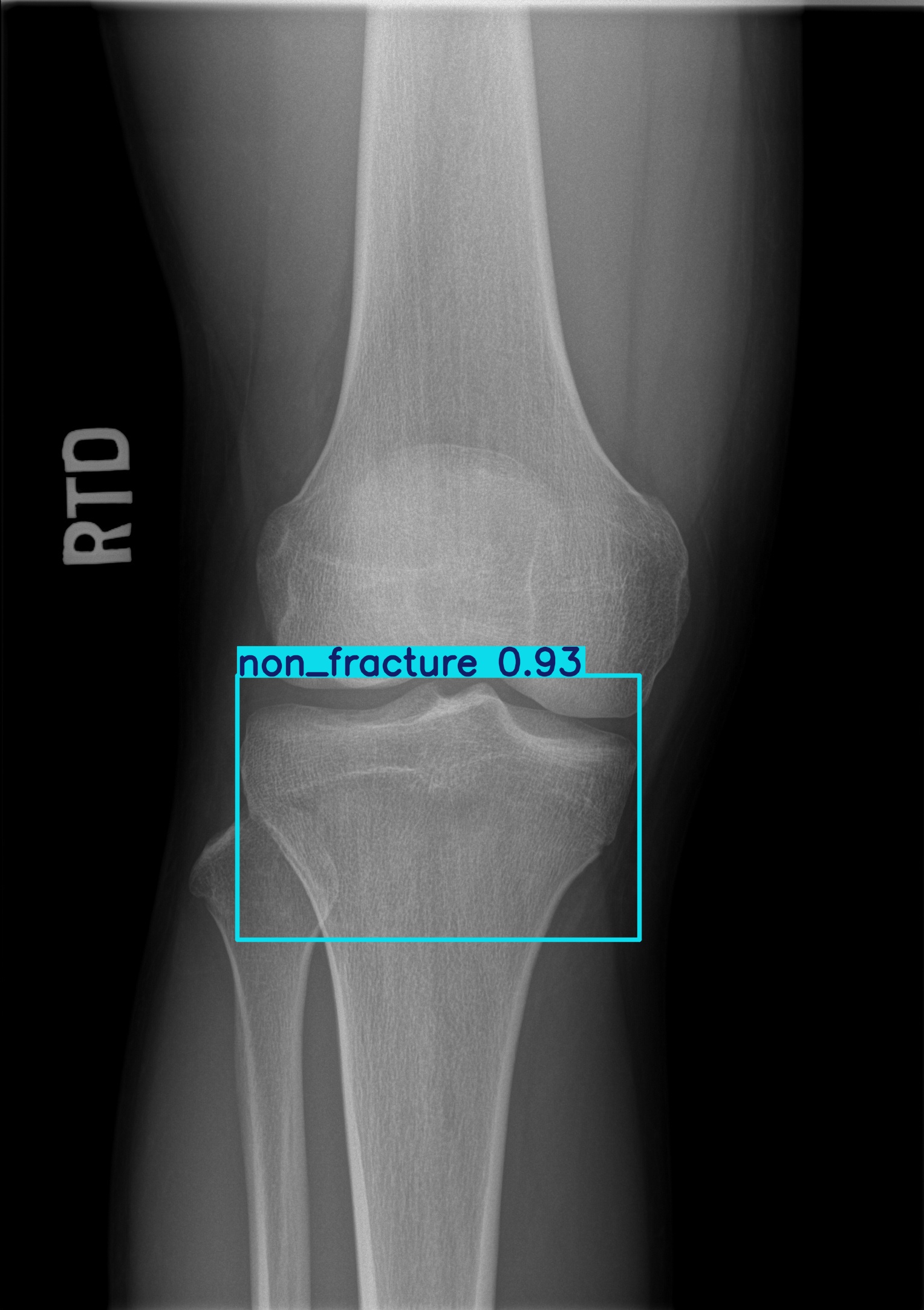 non_fracture_003027622D.jpg