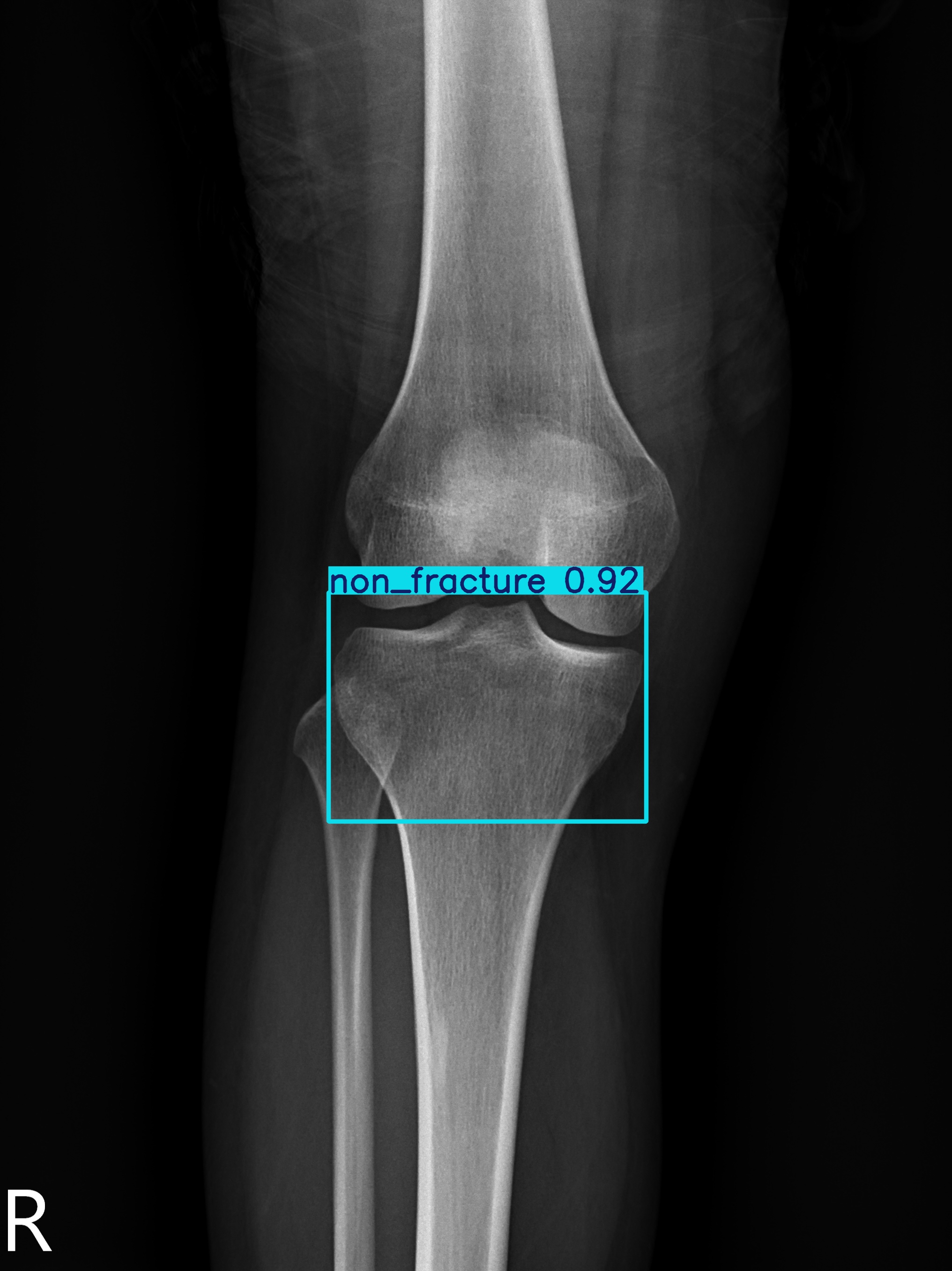 non_fracture_003028148C.jpg