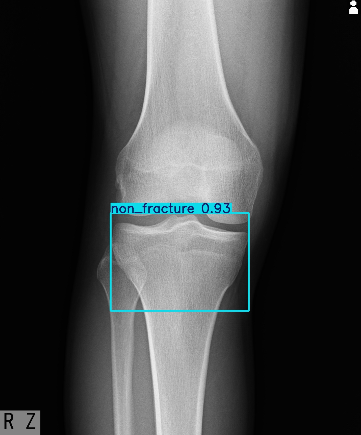 non_fracture_003029987H.jpg