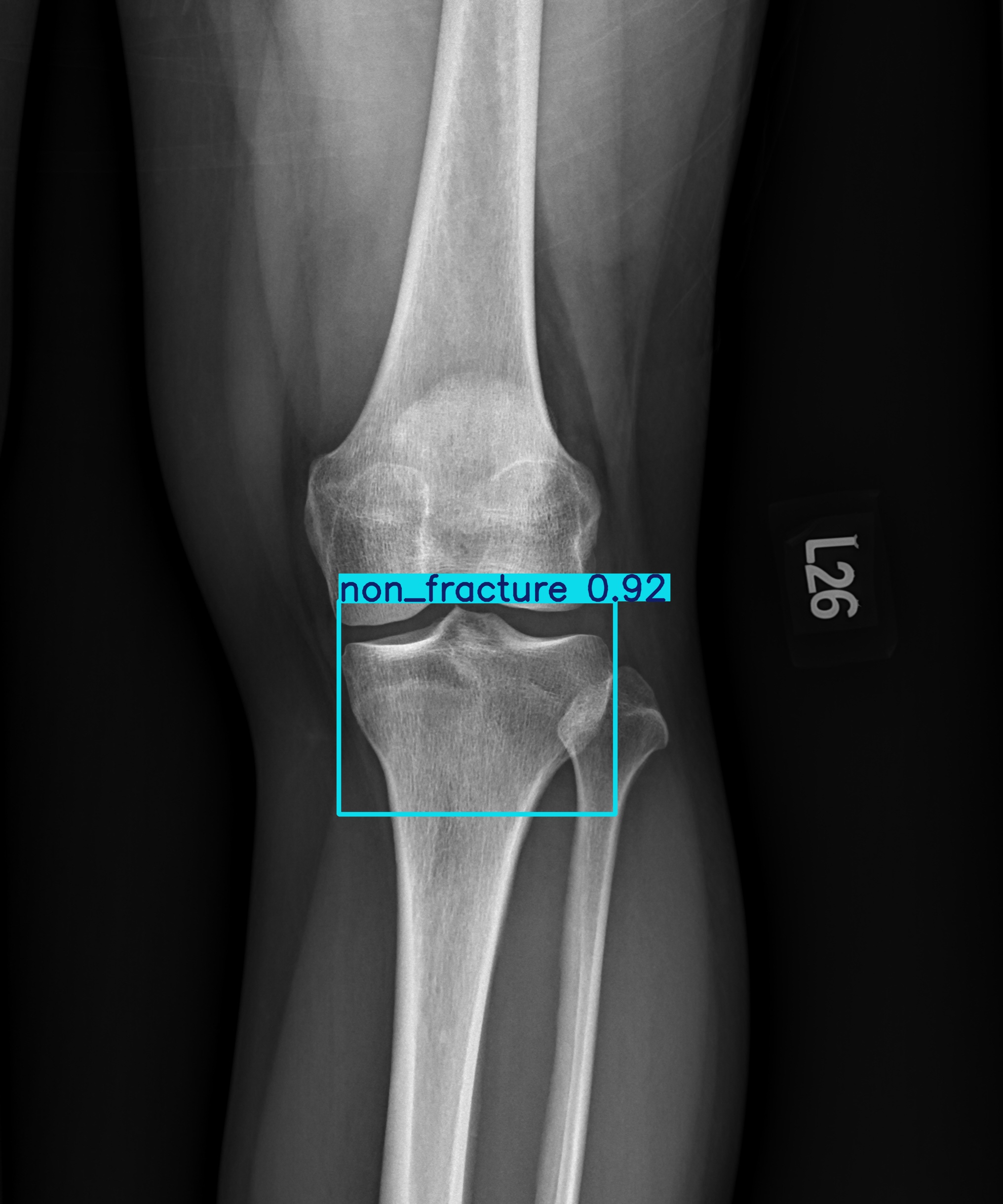 non_fracture_003043225I 2.jpg