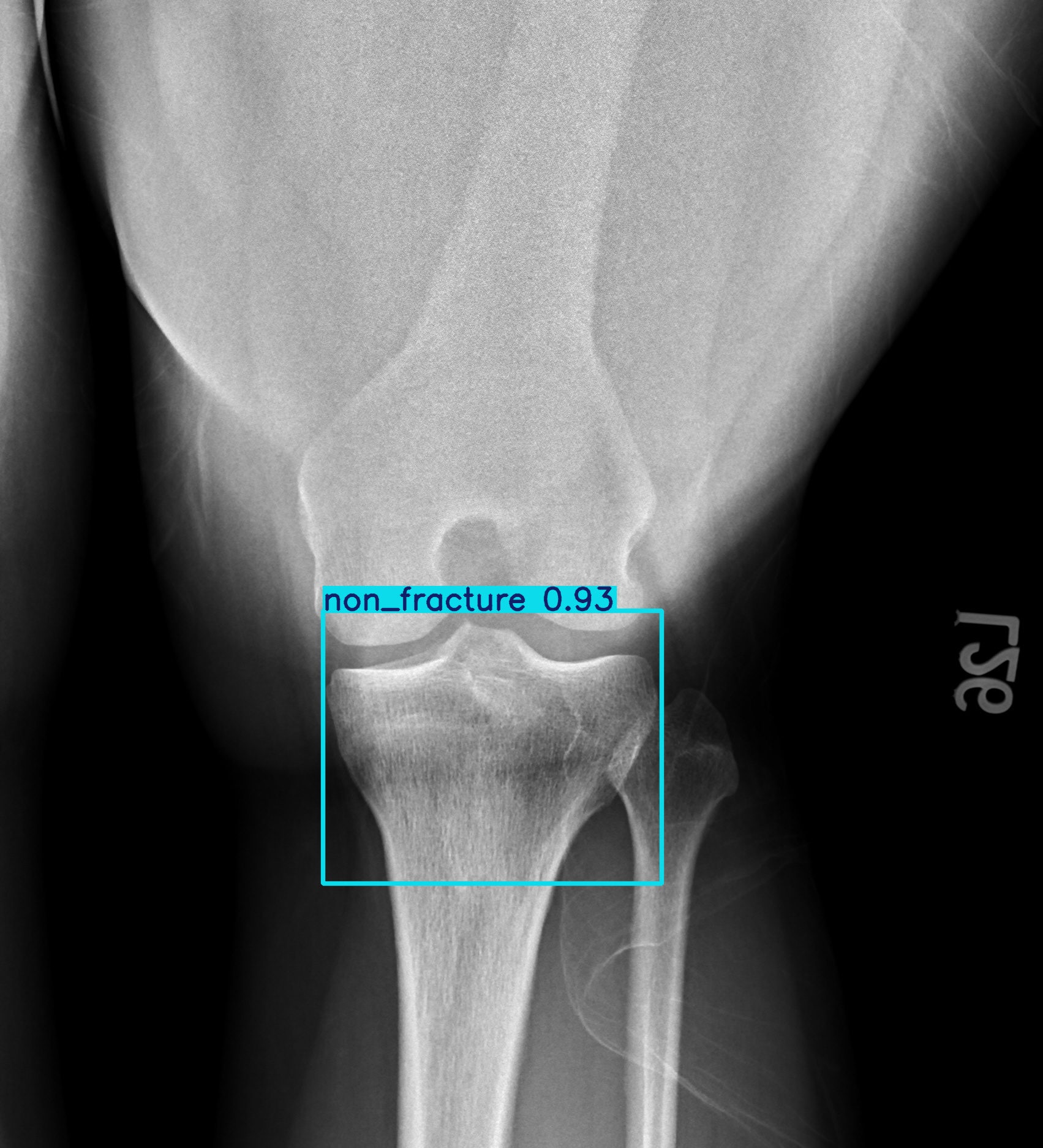 non_fracture_003043225I.jpg