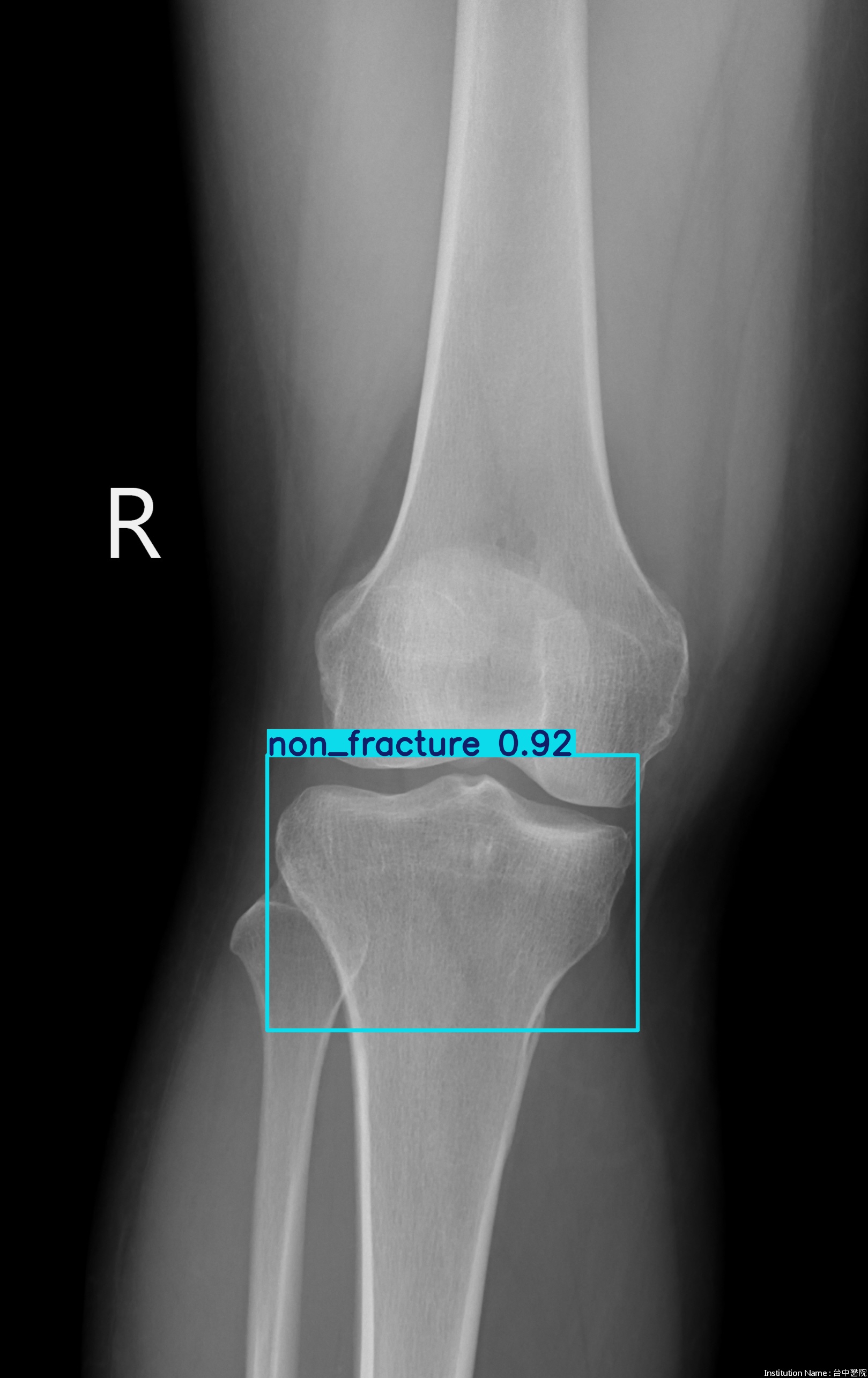 non_fracture_003048968A.jpg