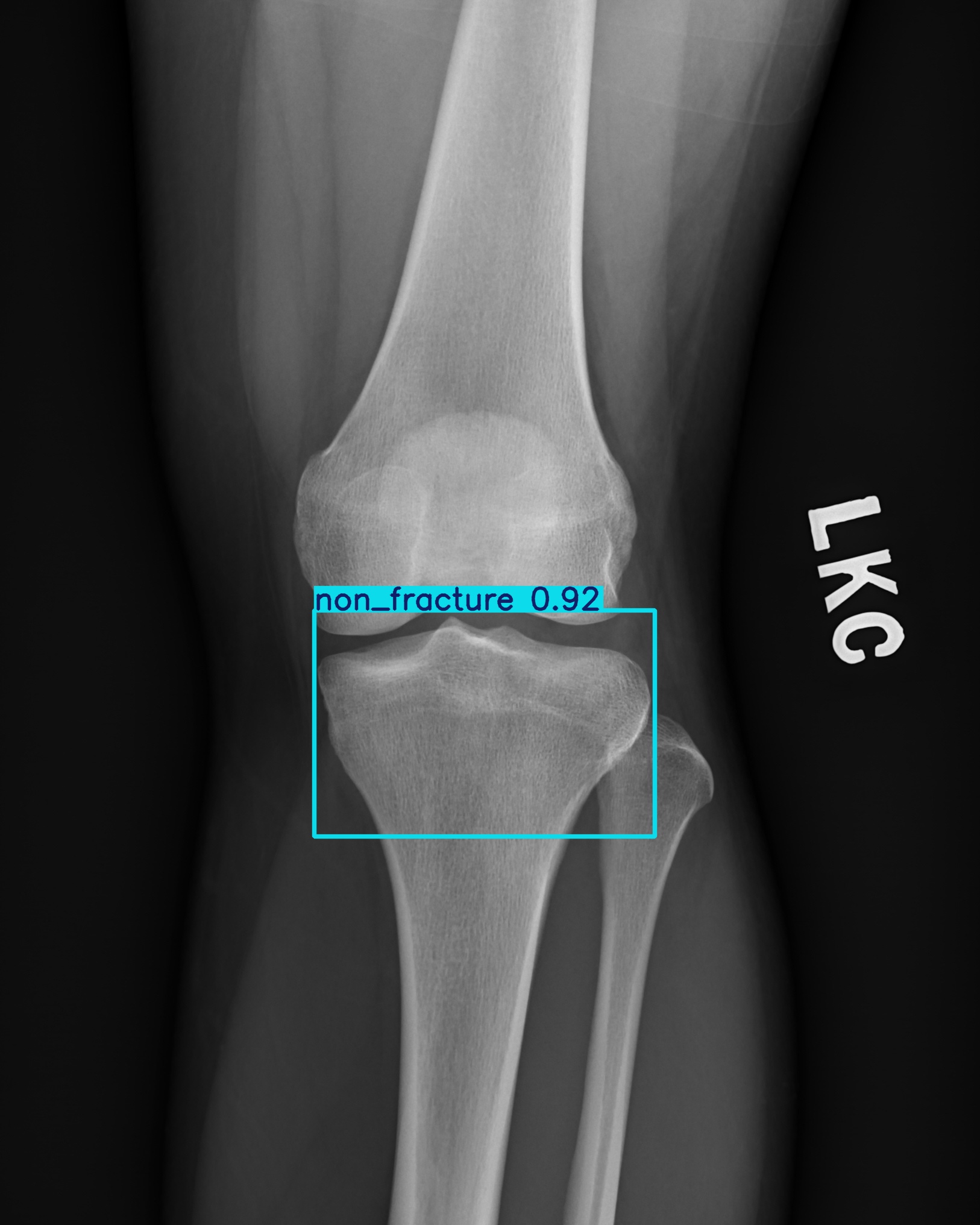non_fracture_003052442G.jpg