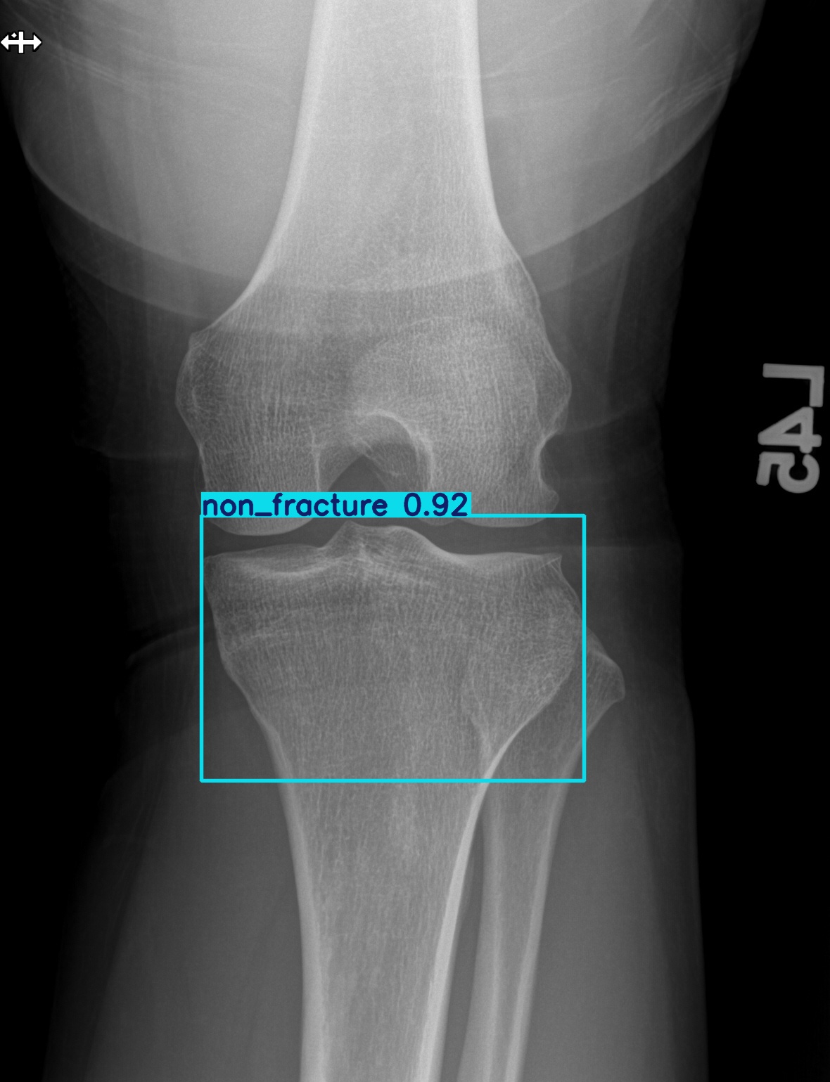 non_fracture_003053797E 2.jpg