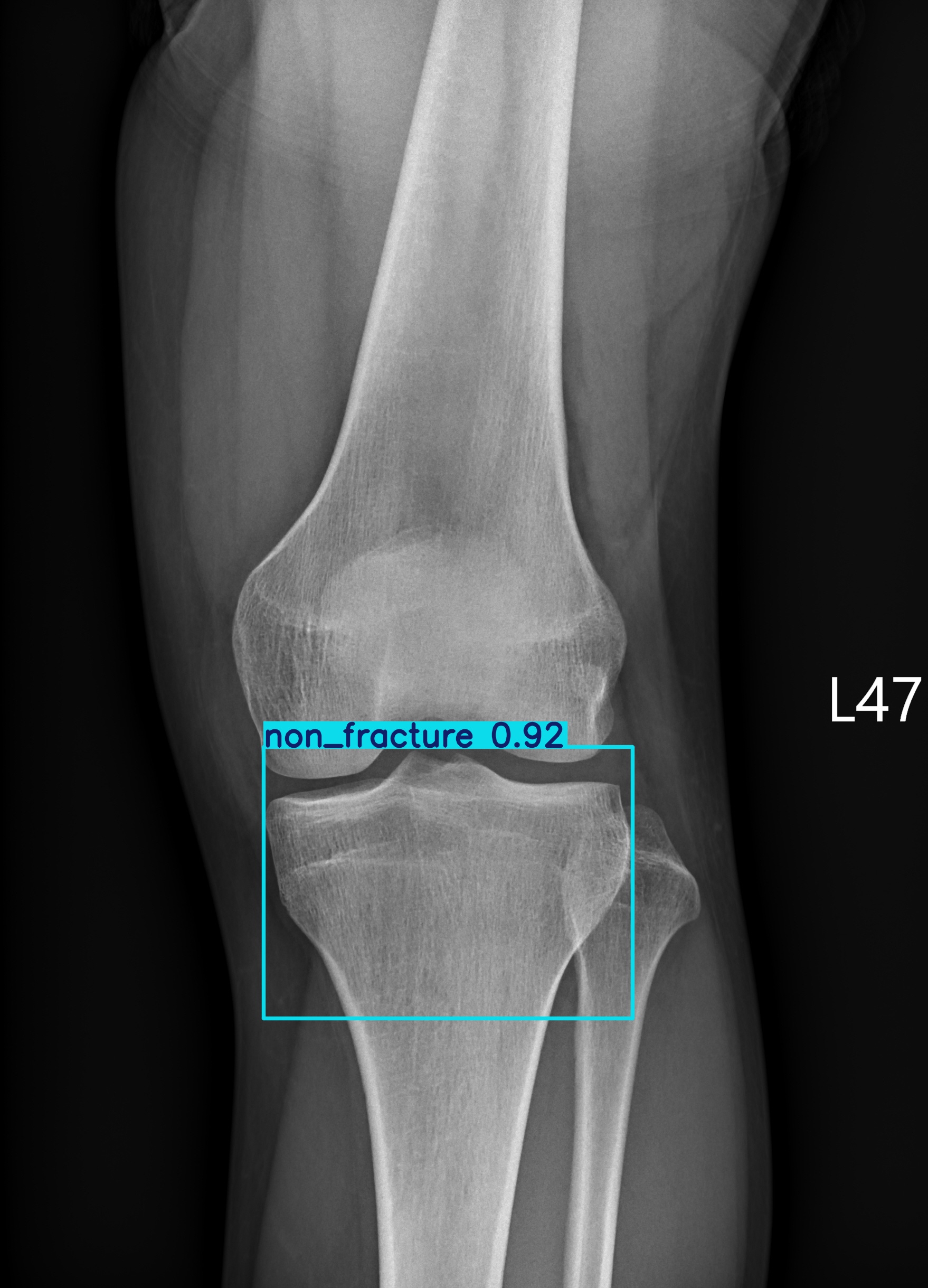 non_fracture_003061014B.jpg