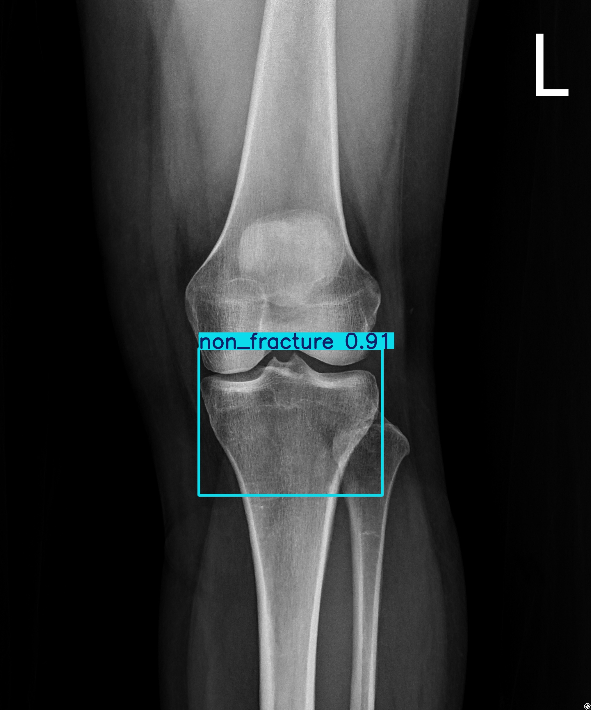 non_fracture_003076154H.jpg