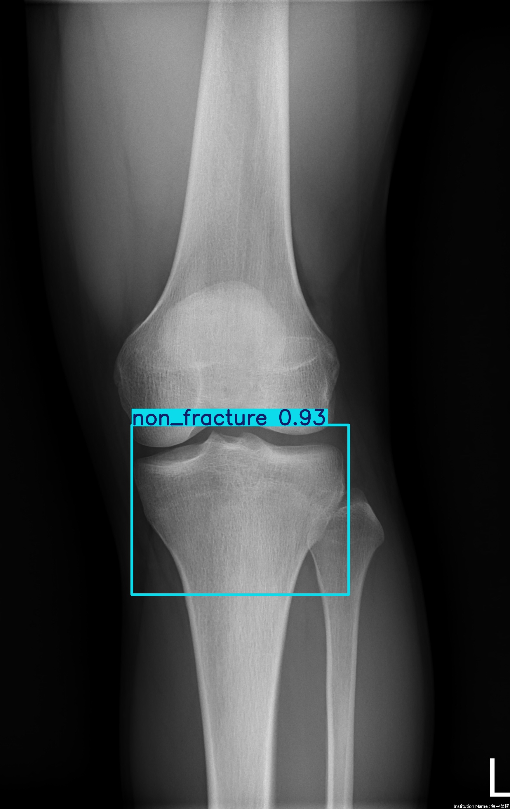 non_fracture_003078241D.jpg