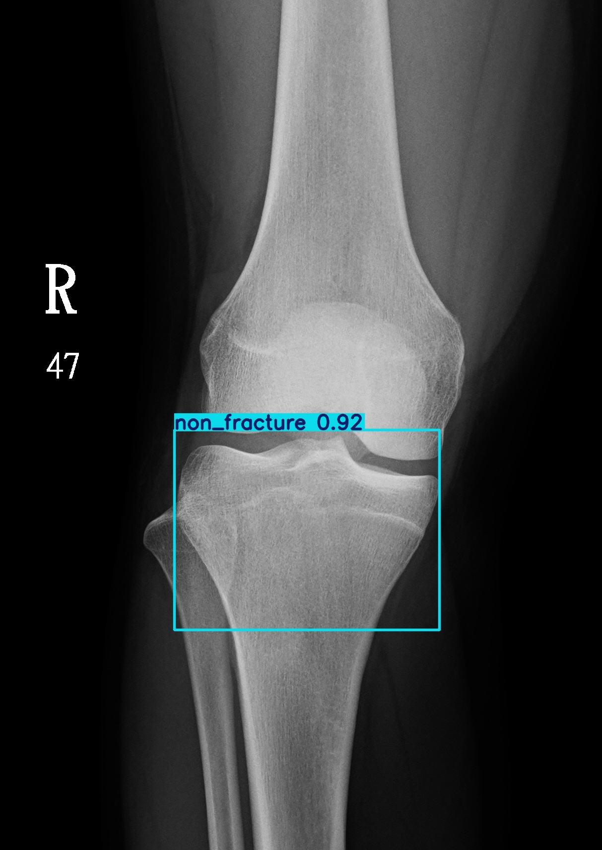 non_fracture_003085945B.jpg