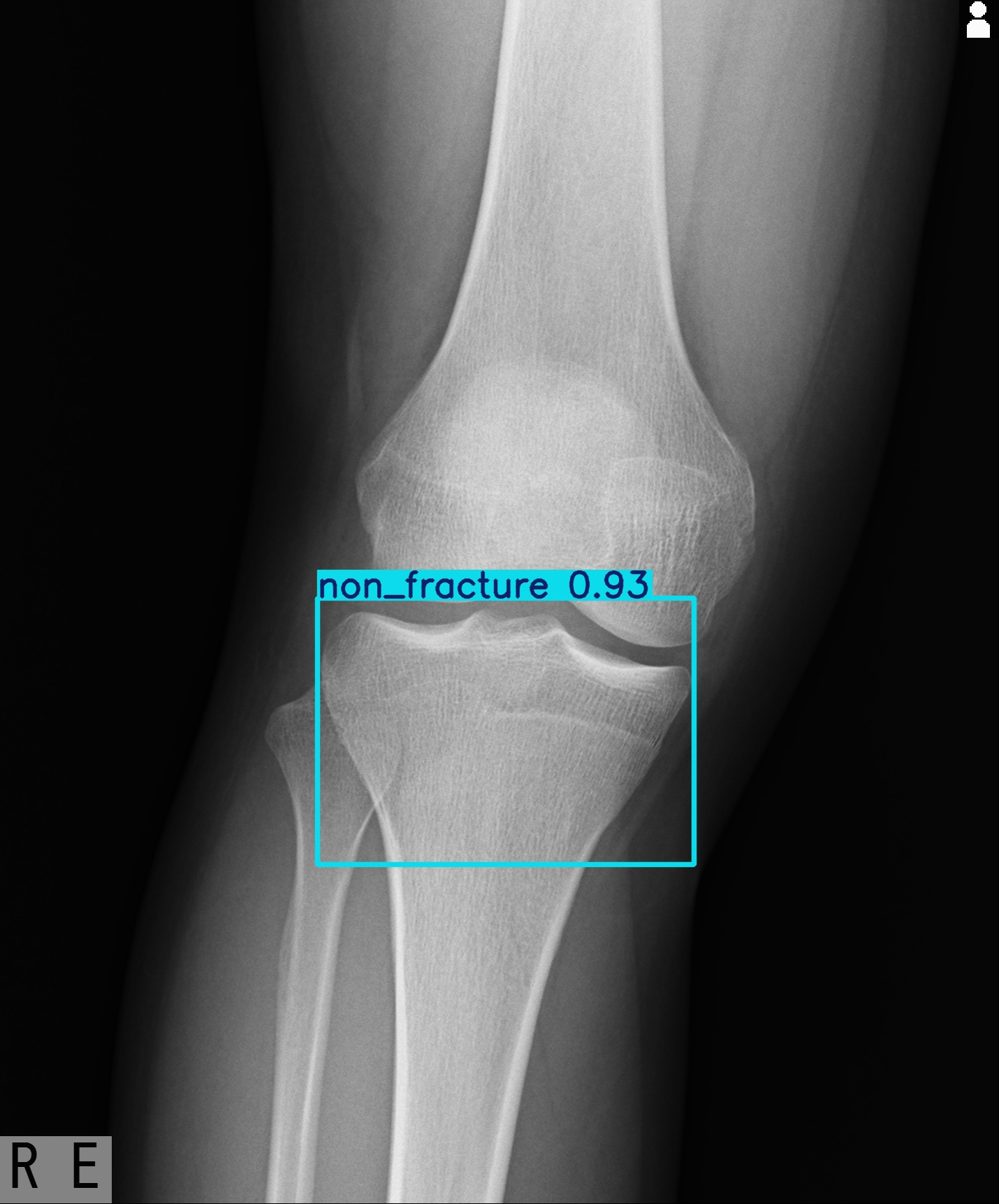 non_fracture_003086133H.jpg
