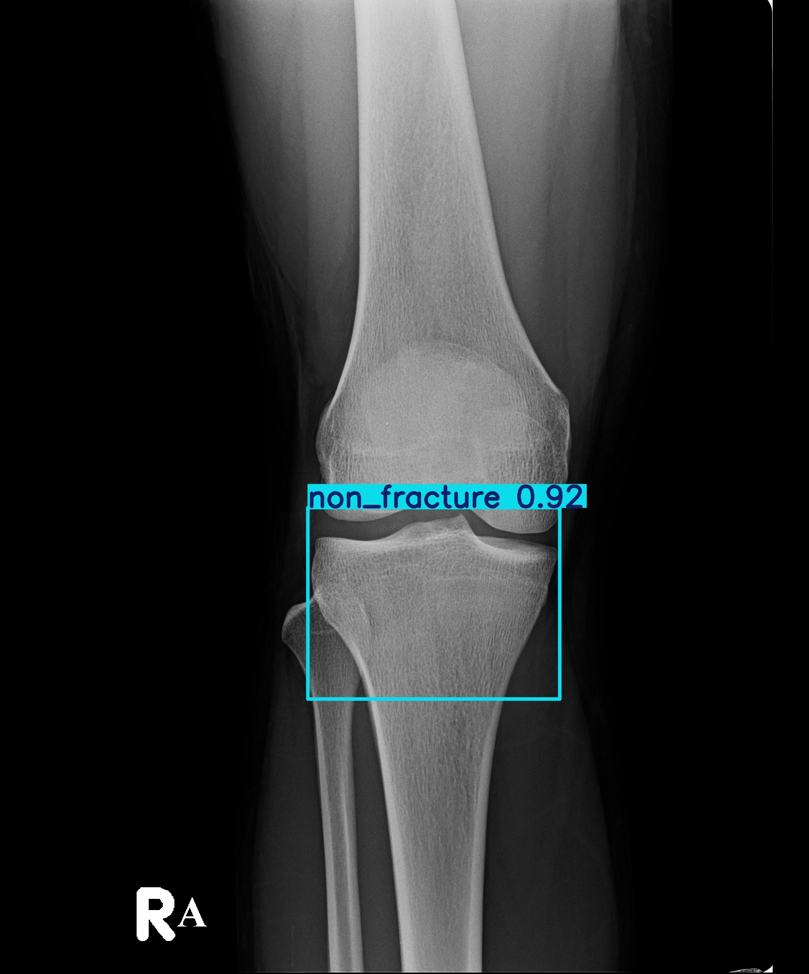 non_fracture_003091033J.jpg