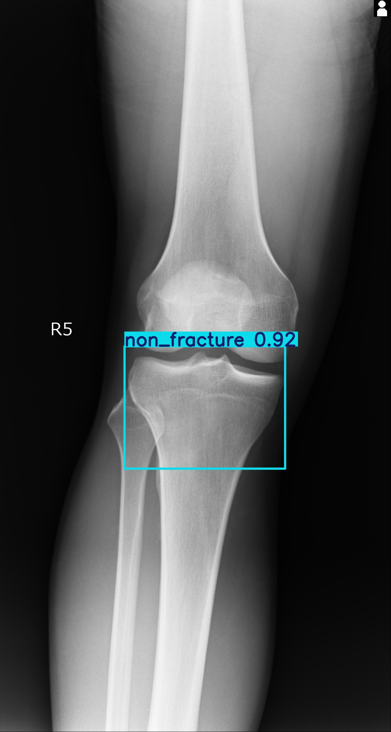 non_fracture_003096139I.jpg