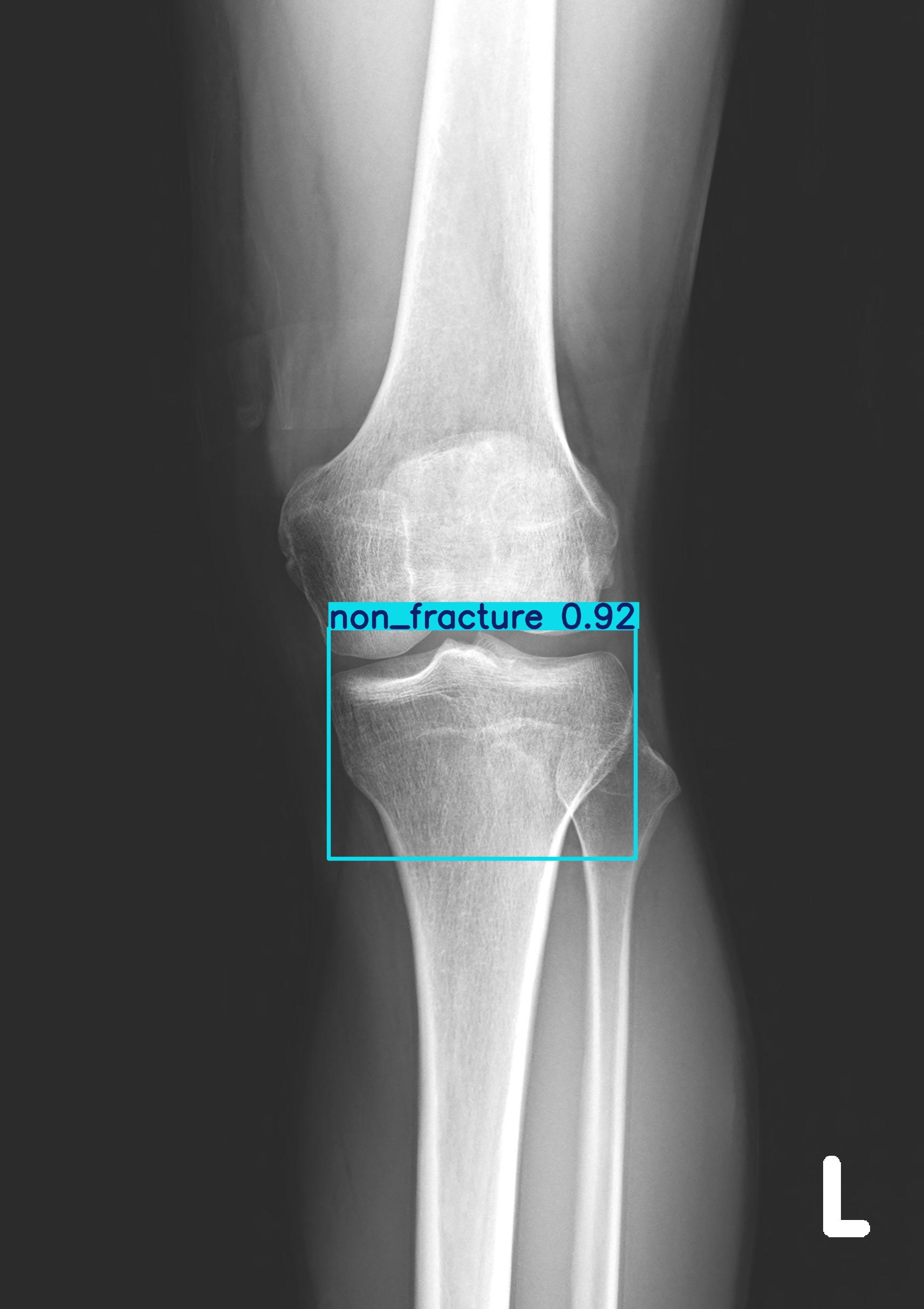 non_fracture_003101298D.jpg
