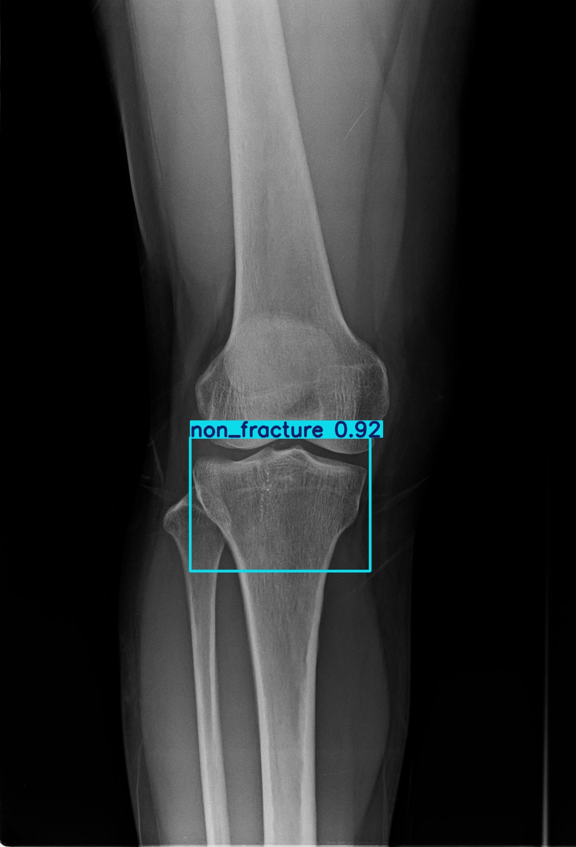 non_fracture_1 (11).jpg