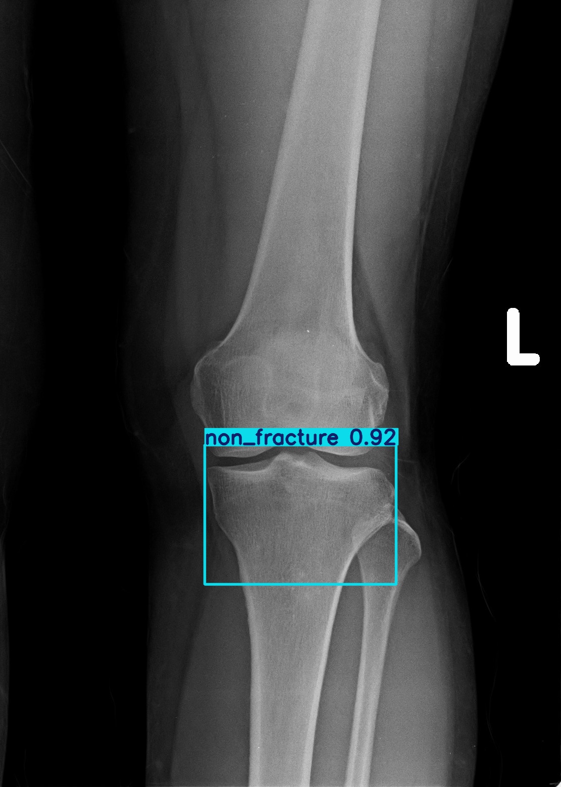 non_fracture_1 (12).jpg