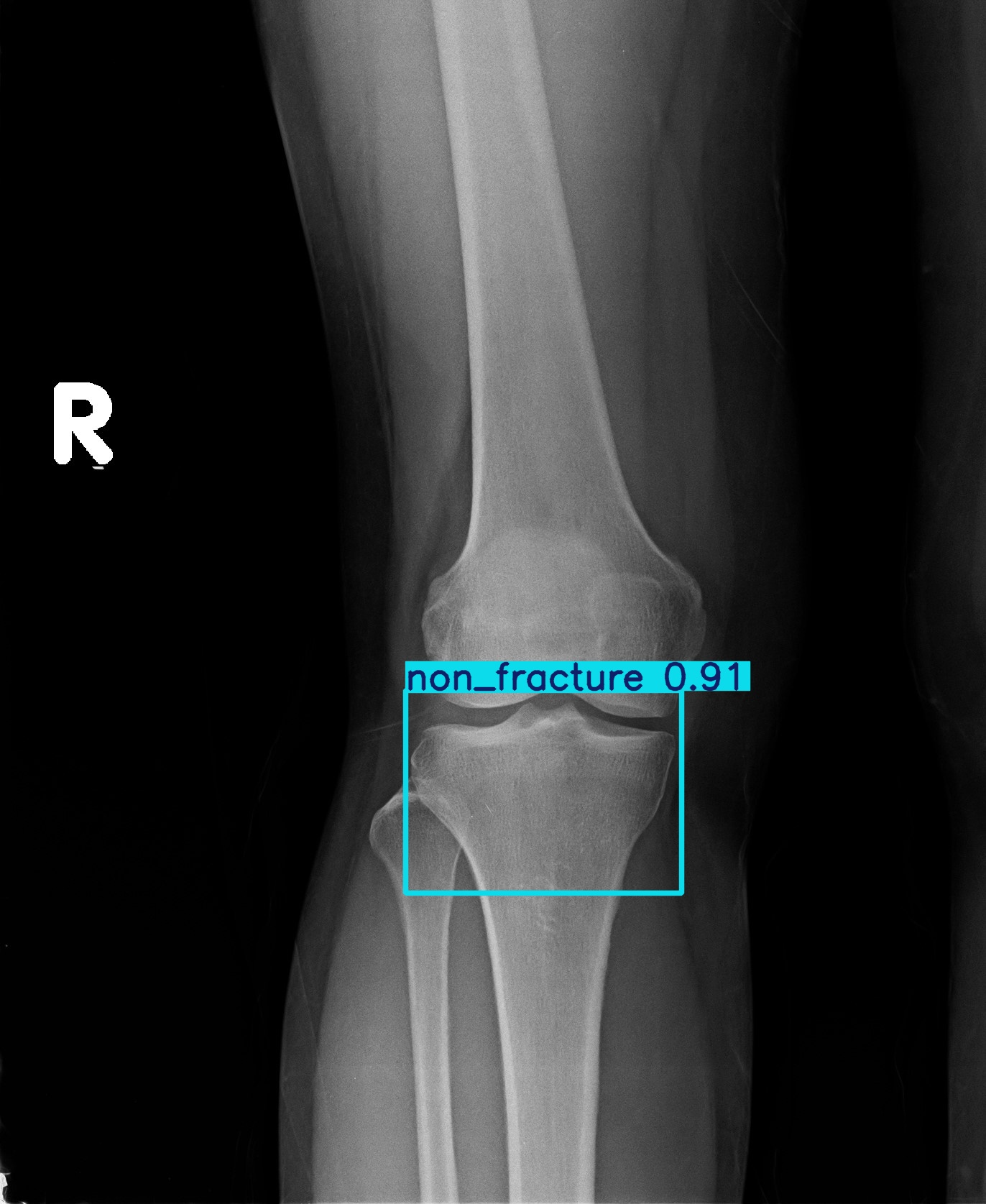 non_fracture_1 (13).jpg