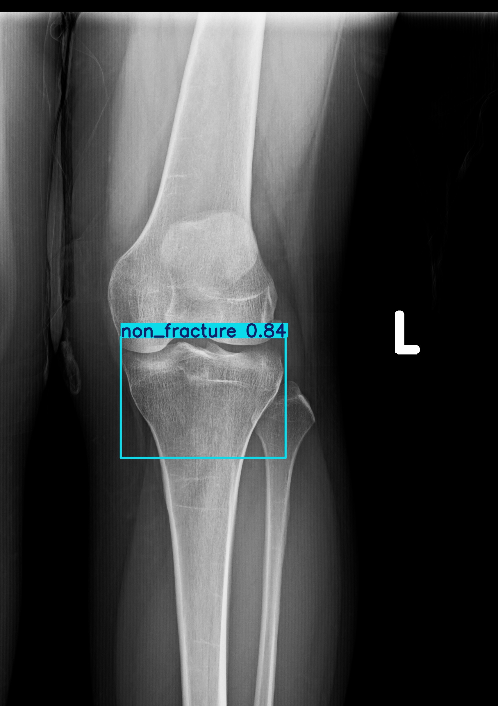 non_fracture_1 (17).jpg