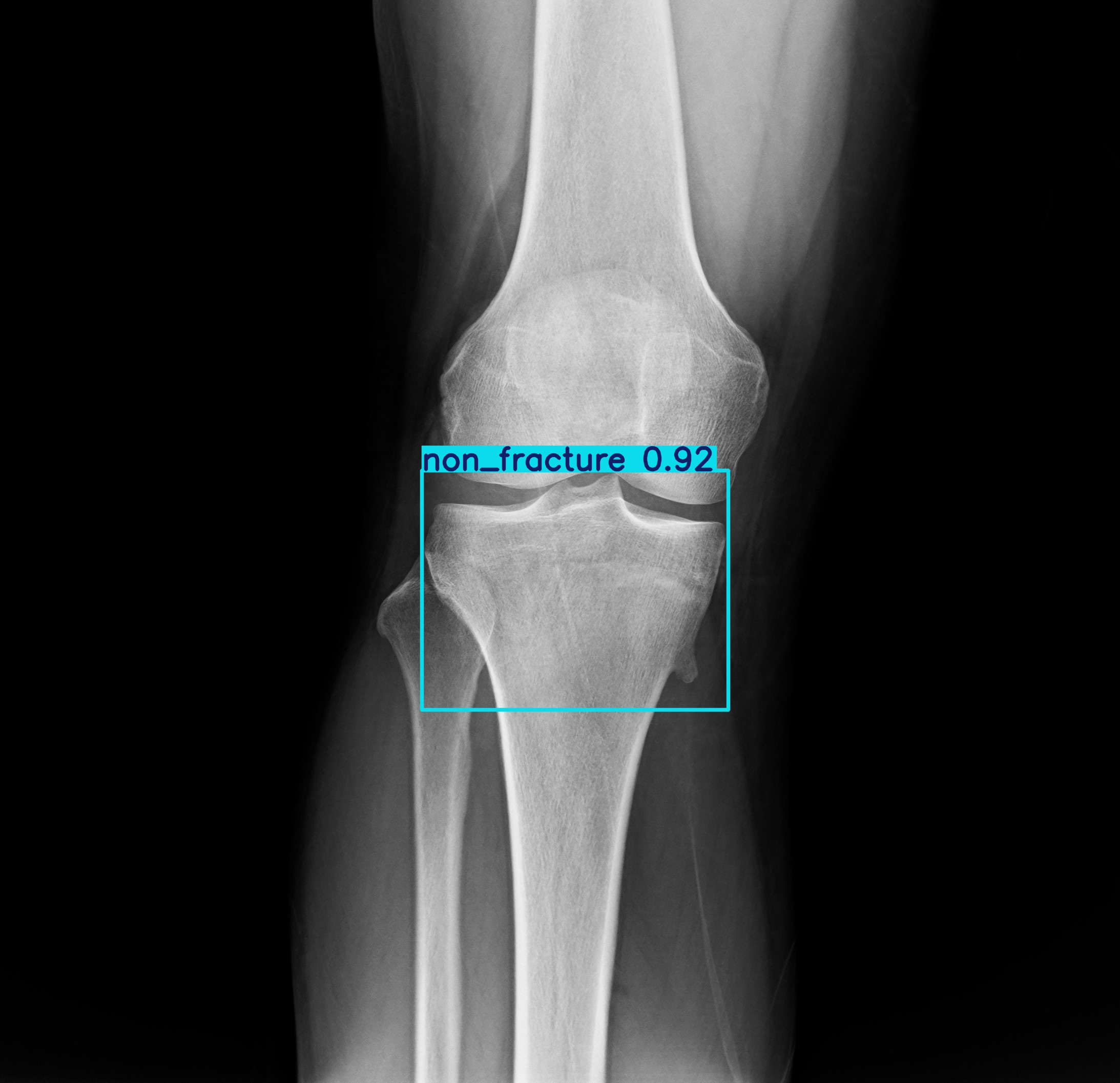 non_fracture_1 (18).jpg