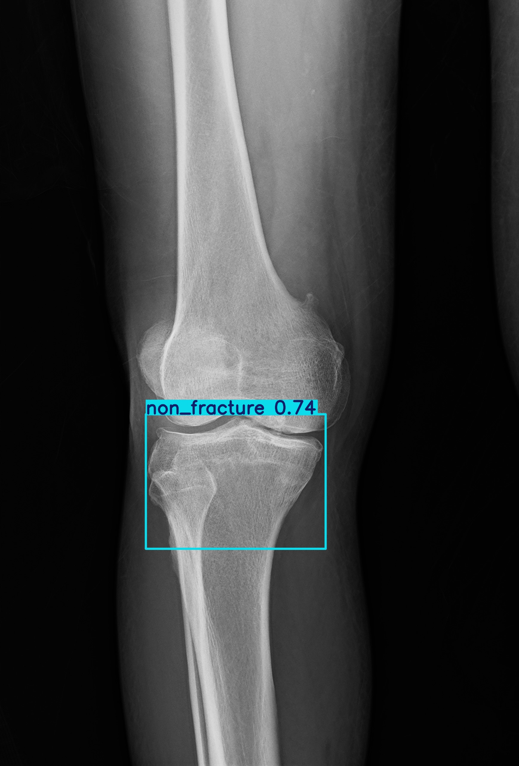 non_fracture_1 (19).jpg