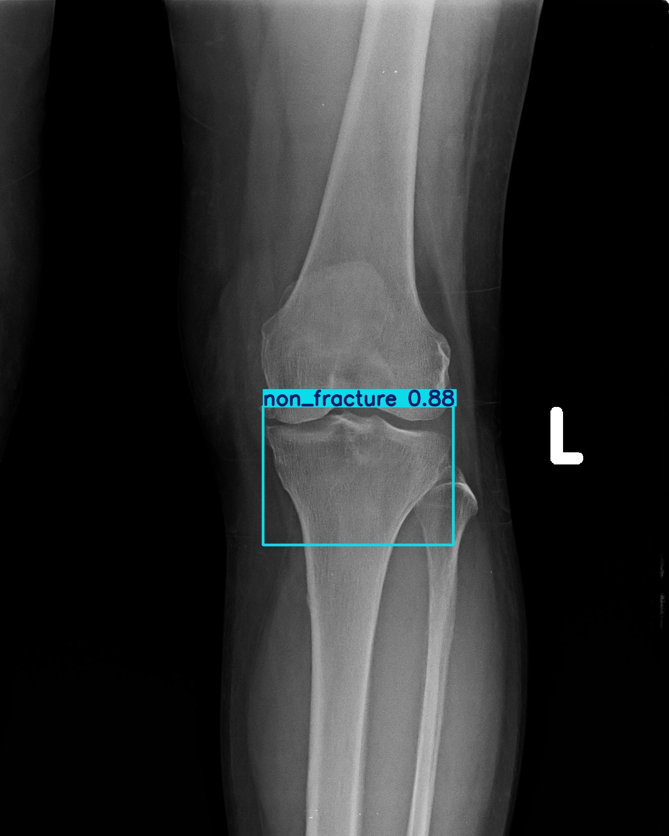 non_fracture_1 (2).jpg