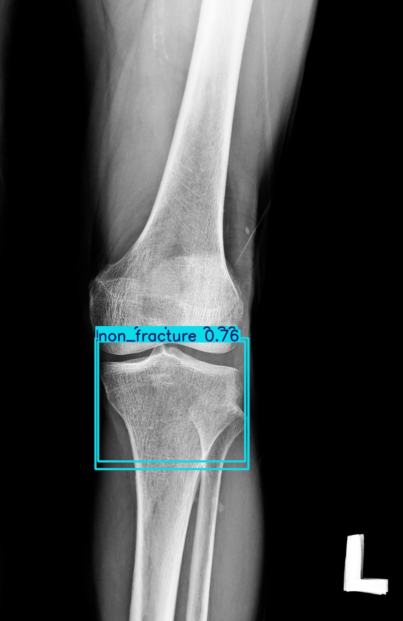 non_fracture_1 (20).jpg