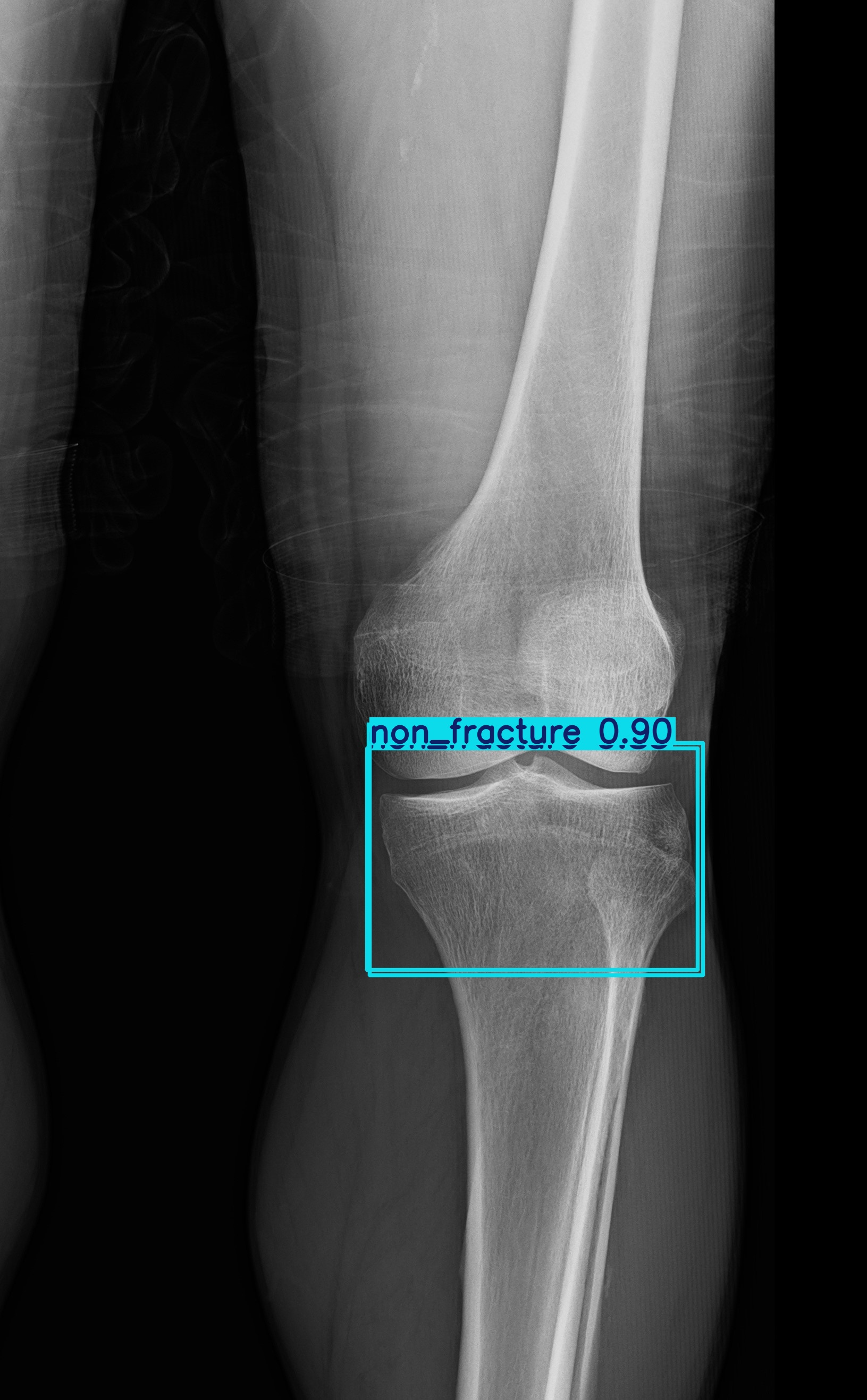 non_fracture_1 (4).jpg