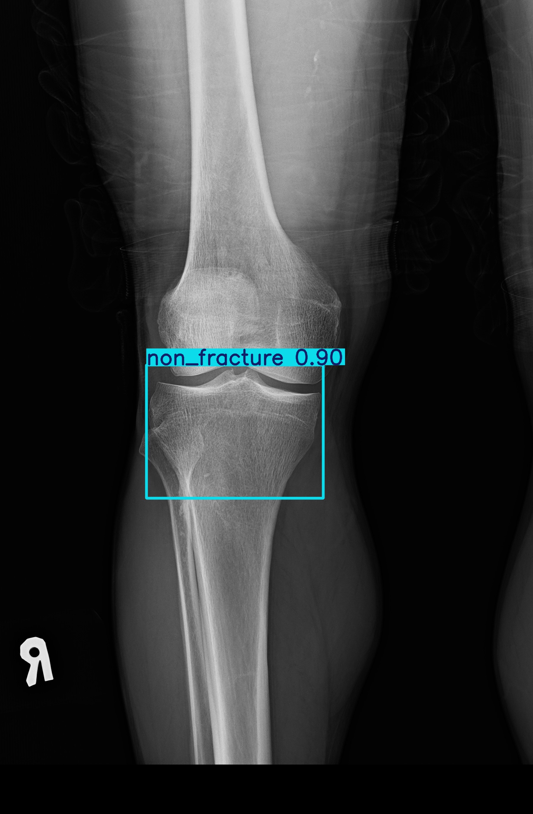 non_fracture_1 (5).jpg