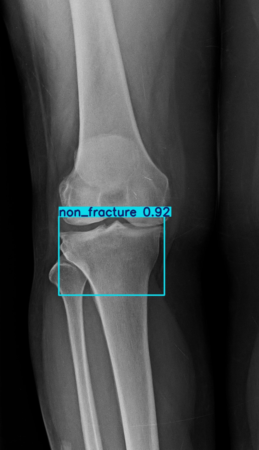 non_fracture_1 (8).jpg