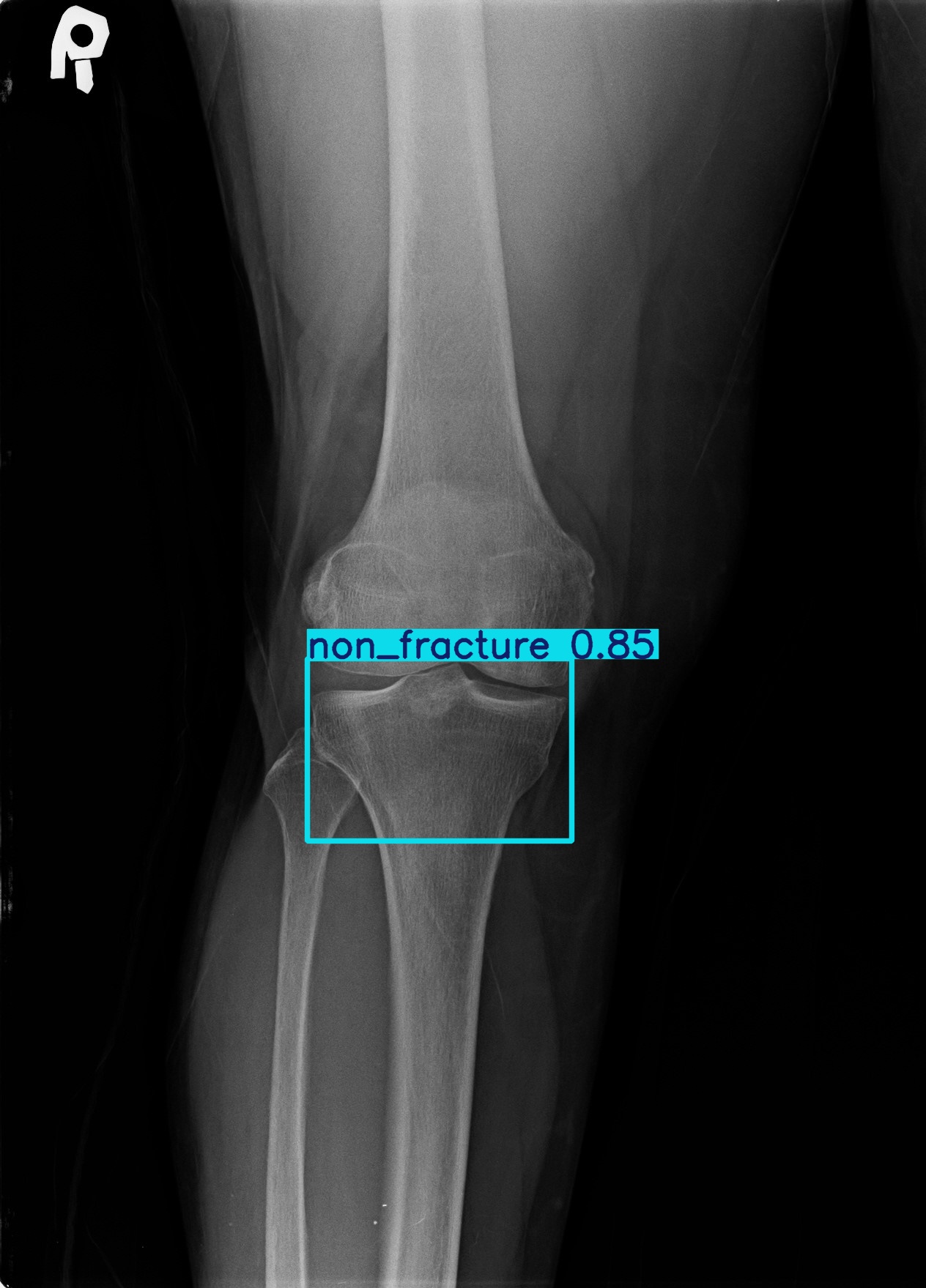 non_fracture_1 (9).jpg